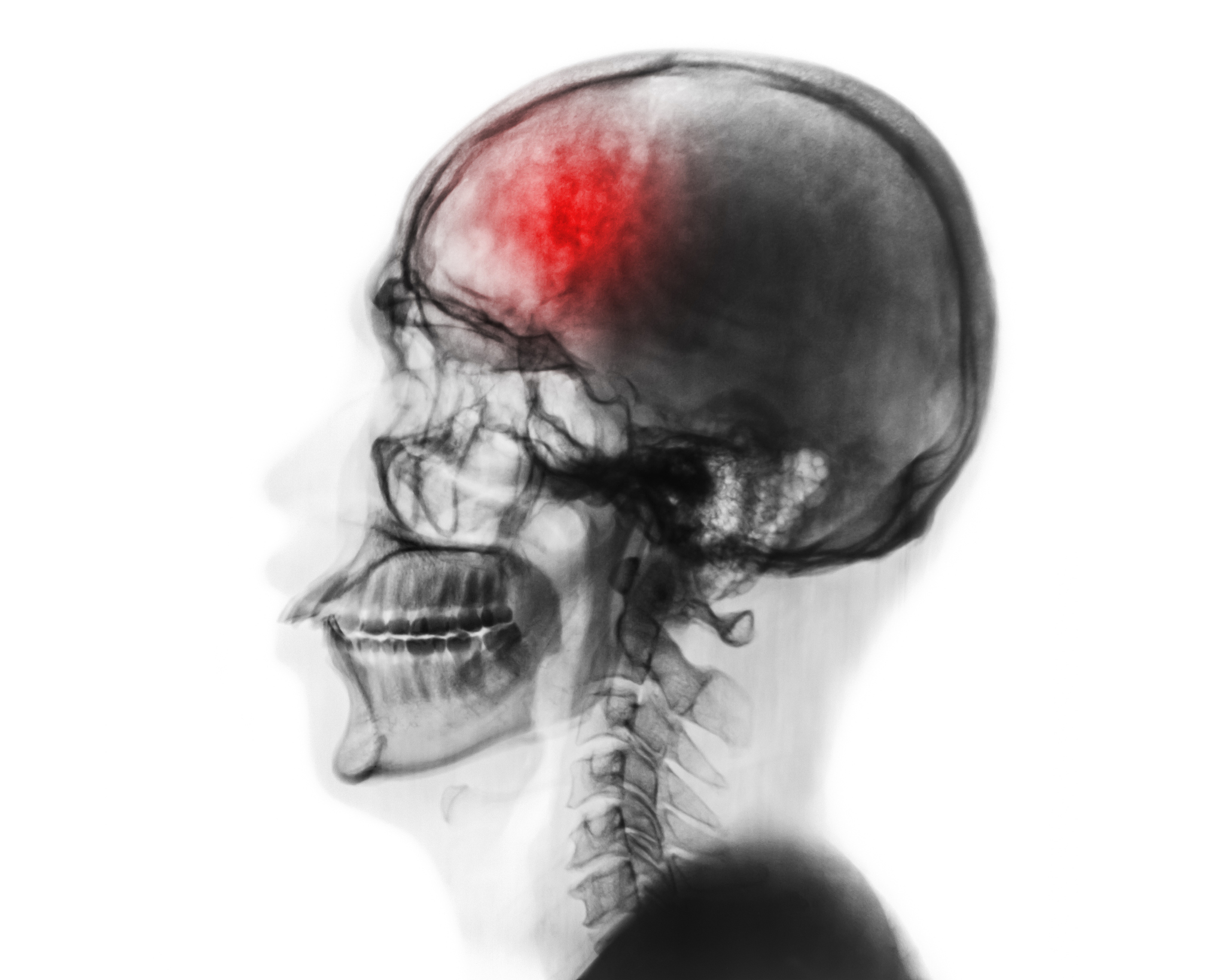 Ultrasound Imaging Prevents Severe Cerebrovascular Events by Enabling Early Detection and Treatment of Floating Thrombus in the Carotid Artery