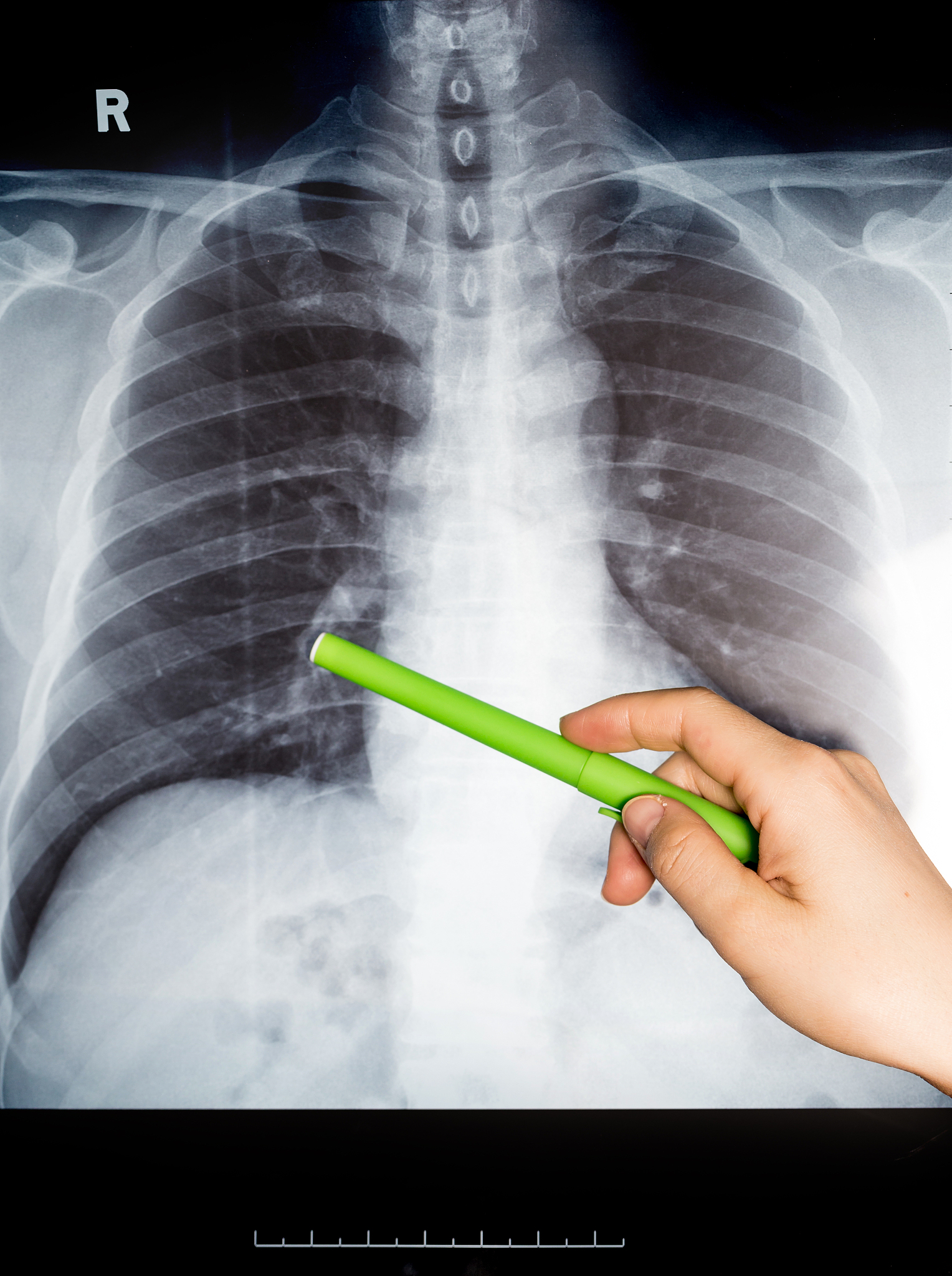 X射线CT成像图像算法详解 - 技术原理与应用