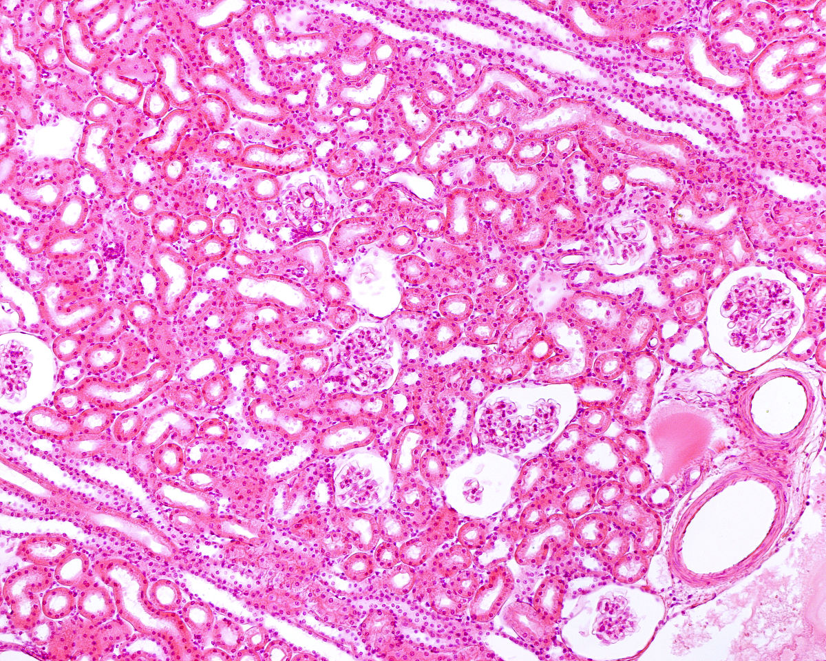 肾组织 1 条肾小球 15-20个皮质和髓质。3-1 个肾小球球性硬化5-6 个肾小球节段毛细血管腔内细胞增多伴单个核细胞、中性粒细胞浸润1-1个肾小球伴大细胞纤维性新月体形成1-2个肾小球节段硬化伴小纤维或纤维细胞性新月体形成0-3个肾小球包氏囊纤维化伴毛细血管襟皱缩余肾小球部分系膜区系膜基质轻度增多或伴系膜细胞轻度增生。肾间质灶性水肿轻度灶性纤维增生中度灶性炎细胞浸润单核细胞、淋巴细胞、浆细胞