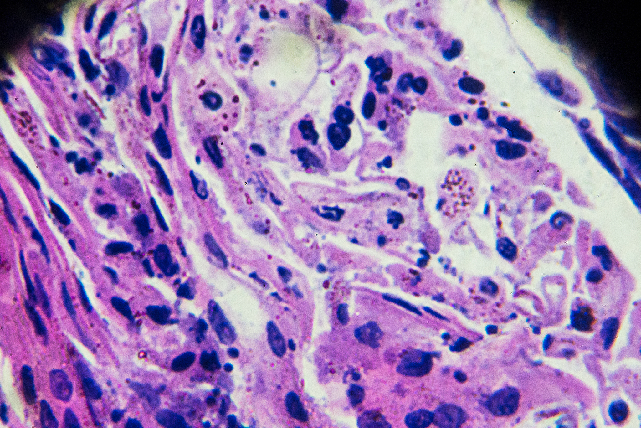 贲门括约肌松弛症状：吞咽困难、胸痛、反酸等