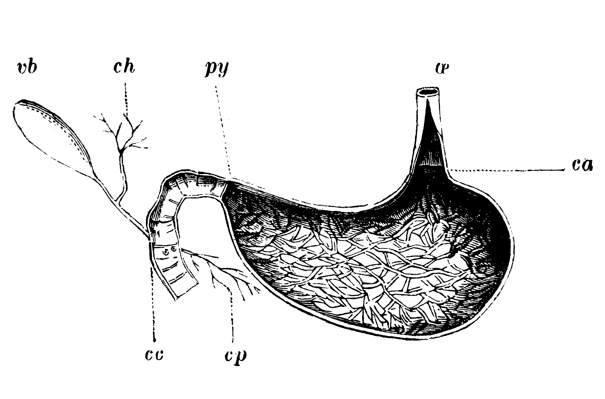 对以下内容进行适当的学术化扩句：显然在流固耦合情况下变形最大的是狭窄处的前端与狭窄处狭窄处的后端也出现了一定的变形我认为出现这样的原因是前端的变形主要是由于气体一开始无法以相同的流量通过狭窄处导致堆积在前端的气体增加压强变大再加上湍流的作用使气道壁面产生了较大的变形。而在这种情况下前端的压力必定很大气流通过狭窄处的速度也必然较大从而对狭窄处之后的气道壁面有一个冲击力也使得气道壁面产生了较大的变形。