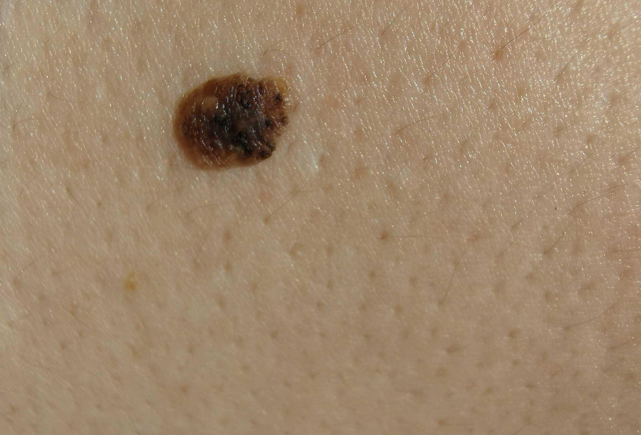 birthmark