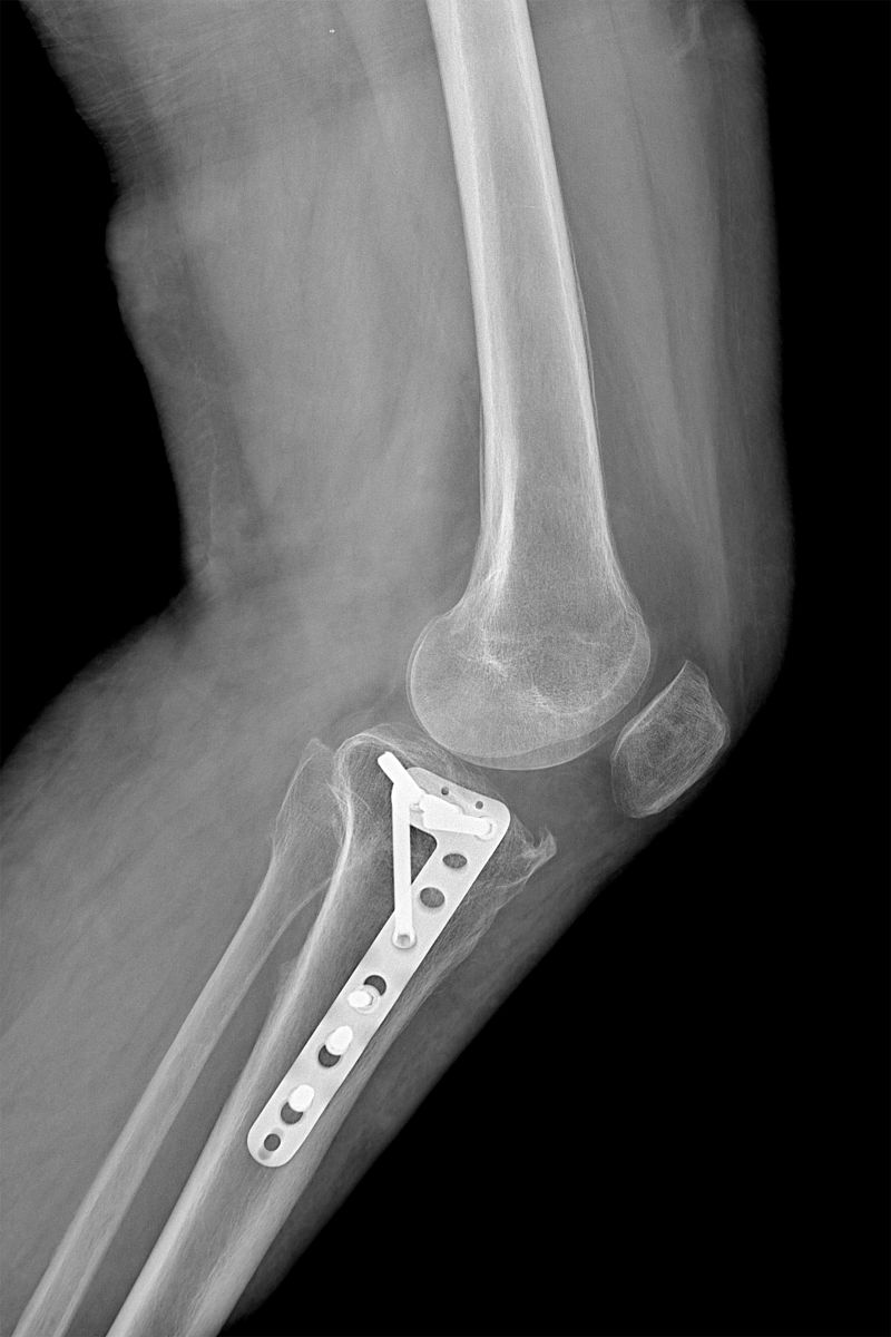 右胫骨平台粉碎性骨折患者切开复位内固定术治疗的重要性