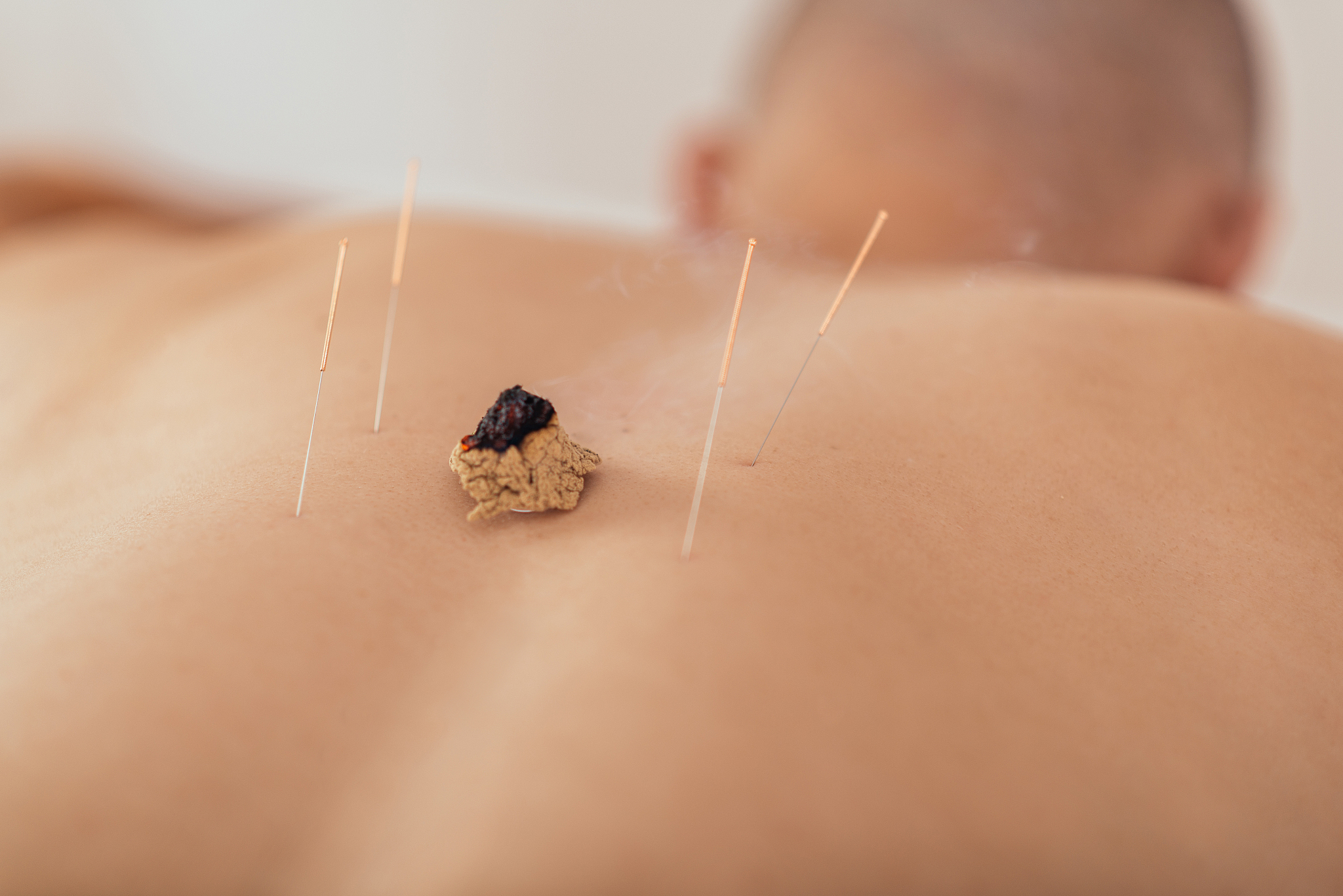 acupuncture and moxibustion treatment