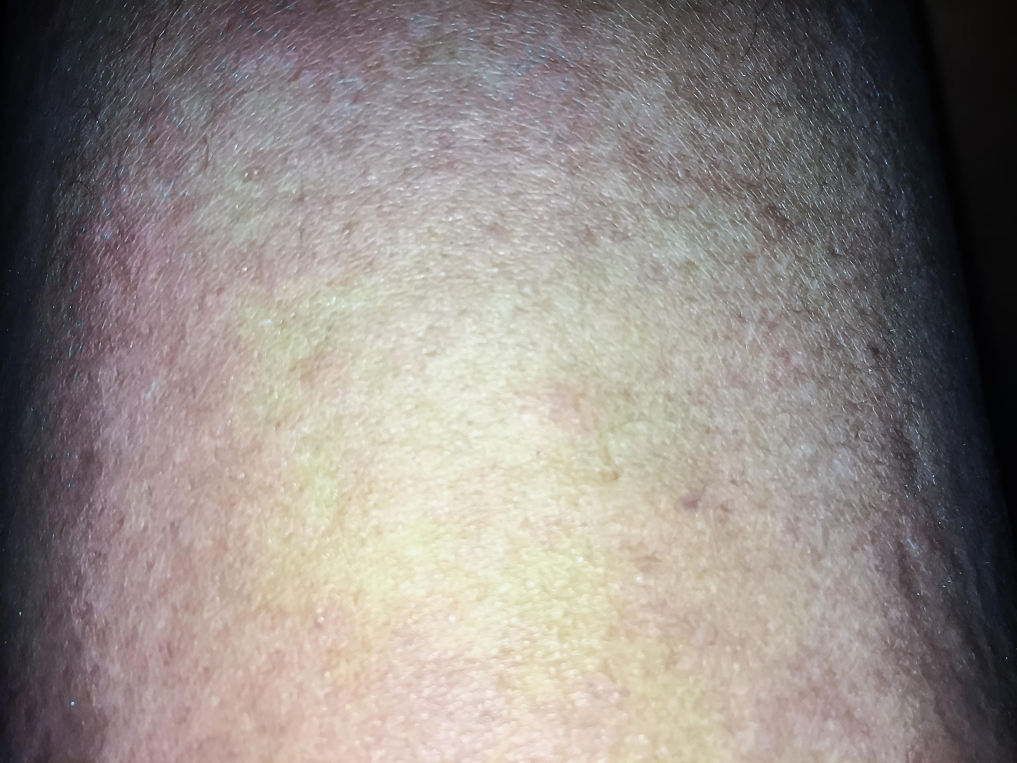 close up view of cold urticaria allergic rash. symptoms of itchy