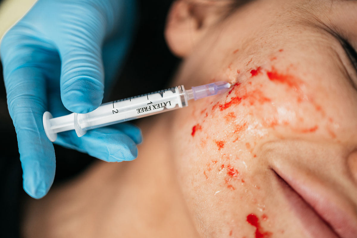 慢性鼻窦炎伴鼻息肉：症状、治疗与预防