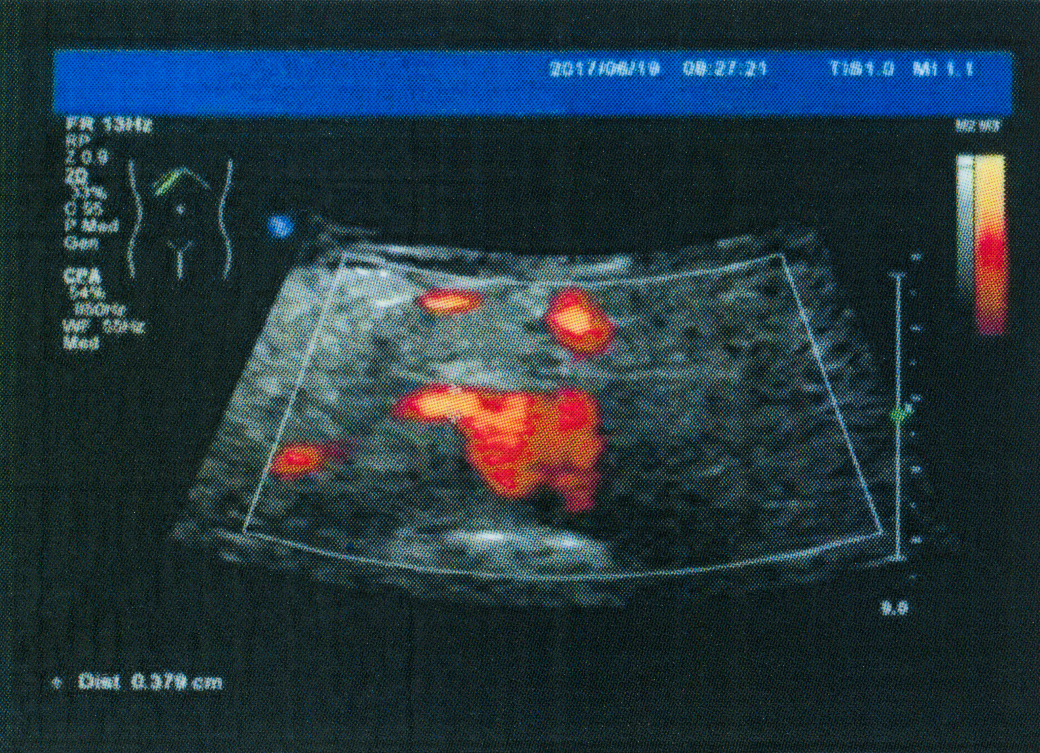 超声造影显示斑块内新生血管，伴局部纤维帽不连续