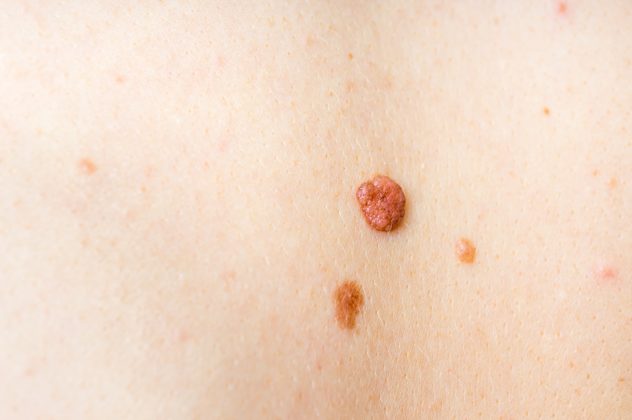 woman with birthmark on her back