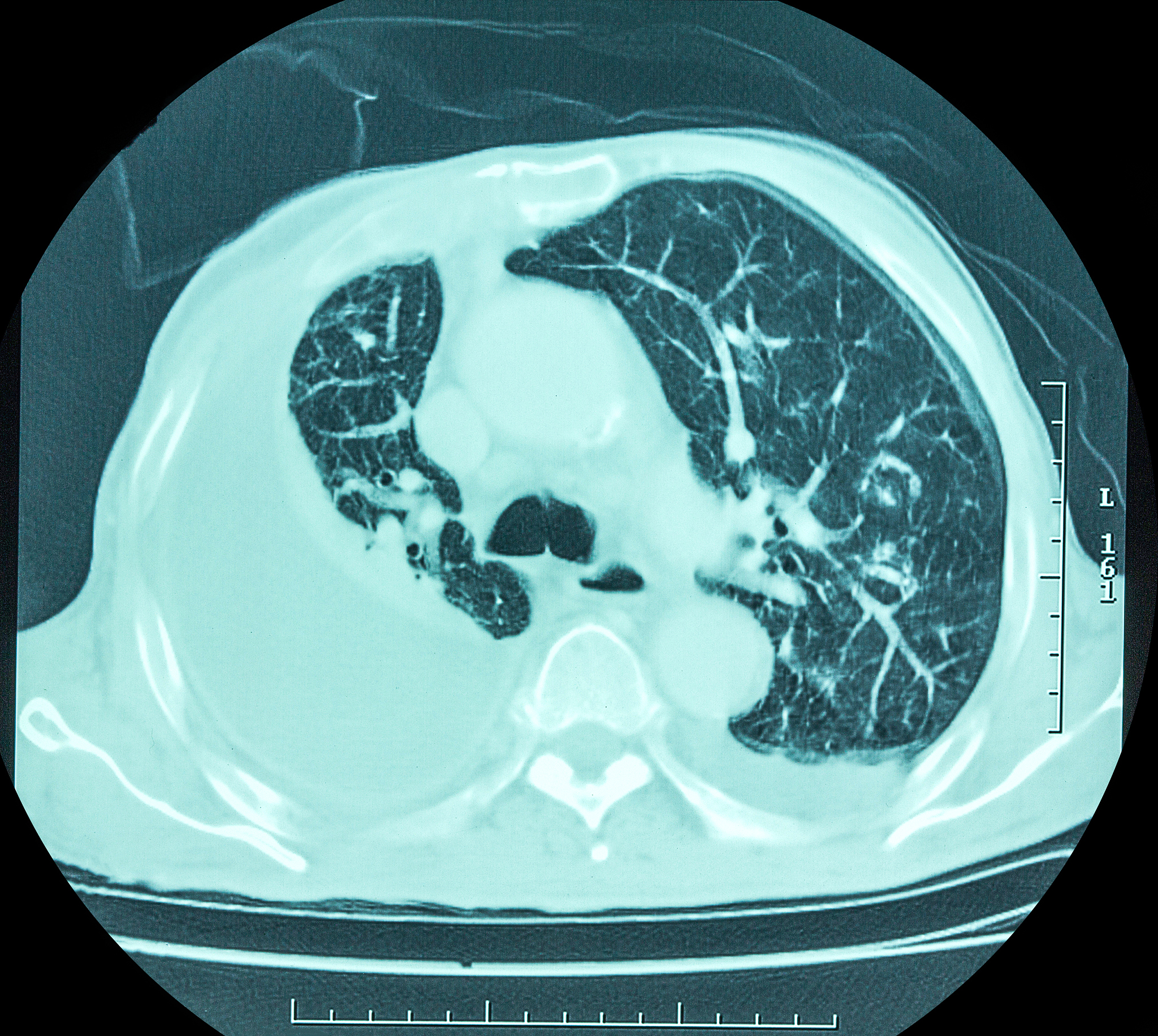 闭合性胸腹部损伤合并创伤性脾破裂：腹腔镜探查与开腹术中麻醉配合及体征监护