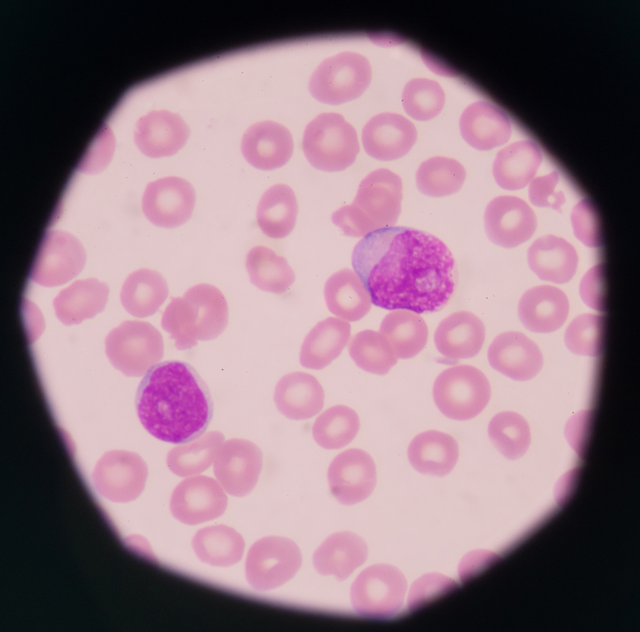 blast cells in peripheral blood images.