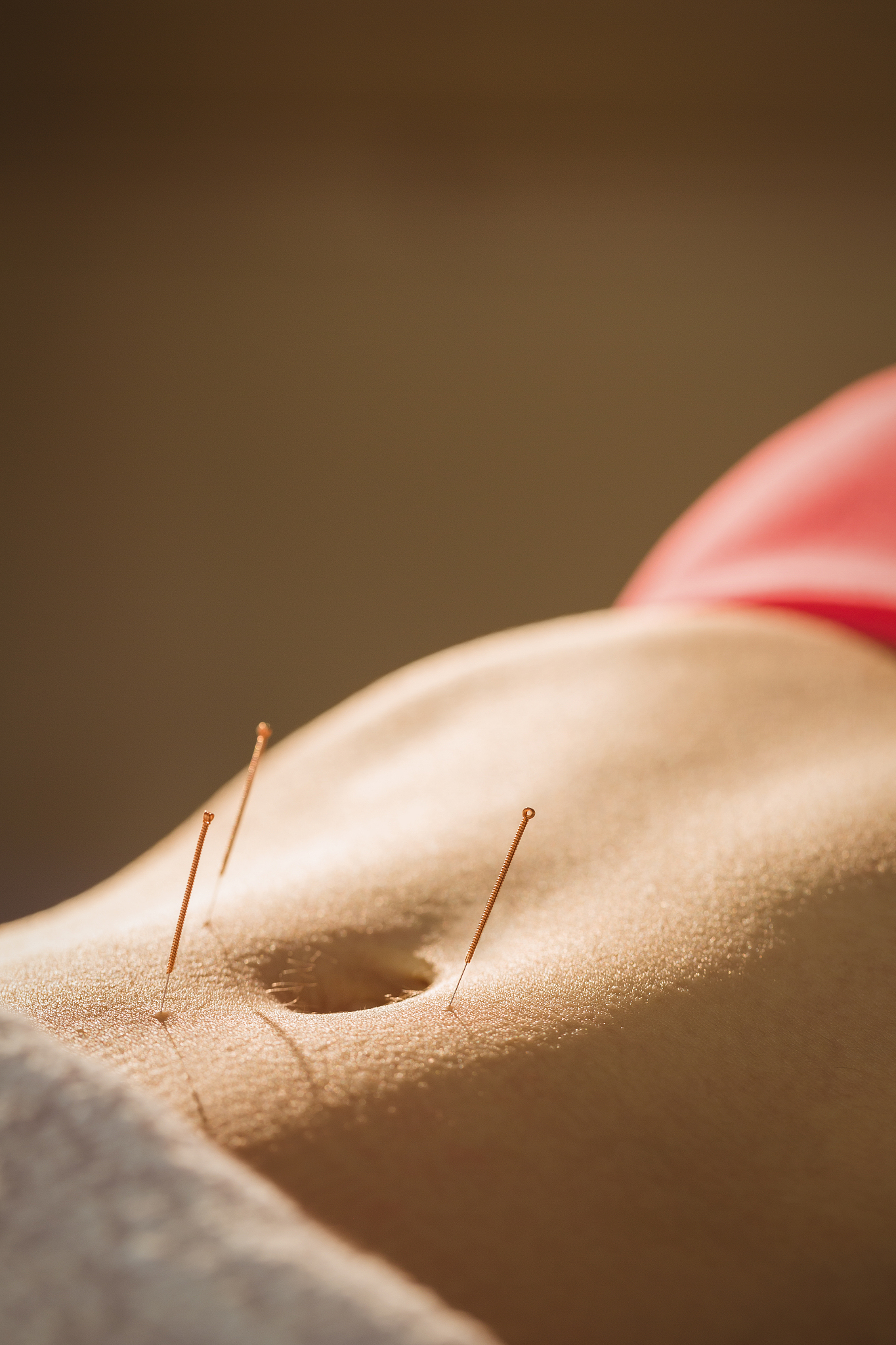 young woman getting acupuncture