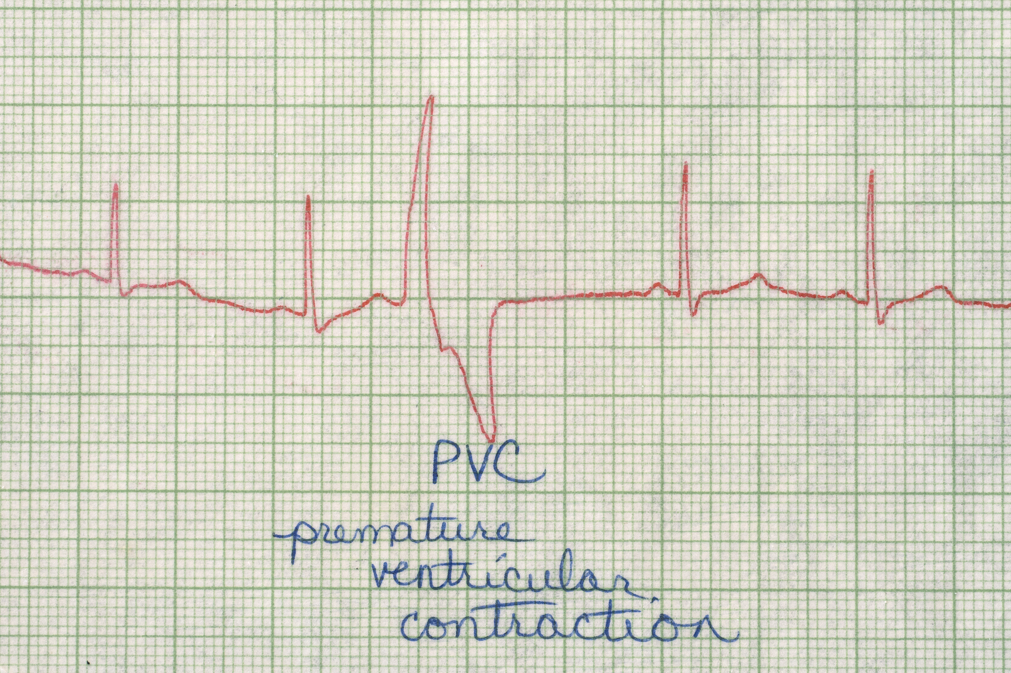 对比期外收缩、心室上心搏过速、心室心律失常及心搏过缓心电数据的均值方差变化程度