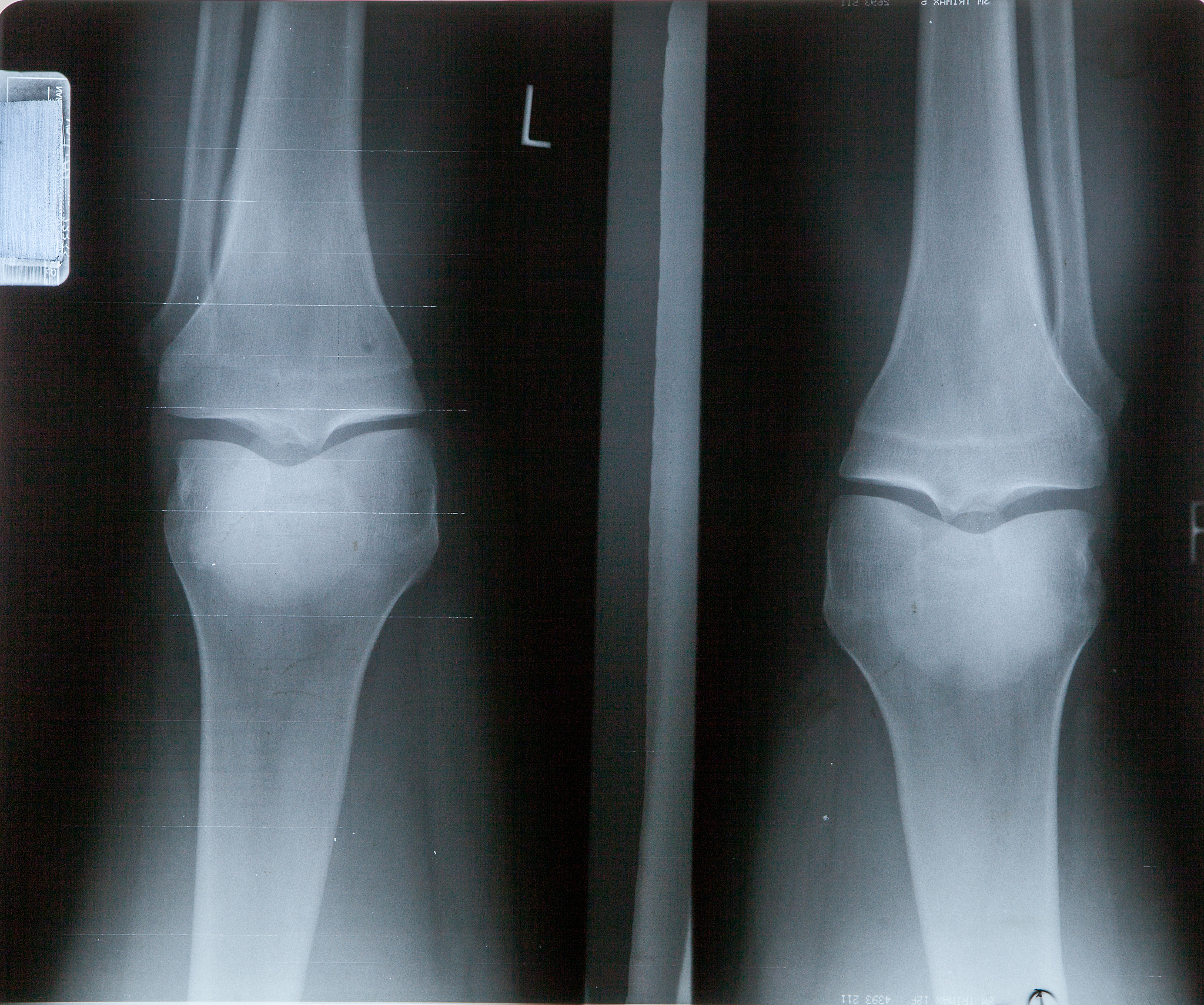 滑囊炎引起膝盖用手摸骨头晃动有声音怎么回事？