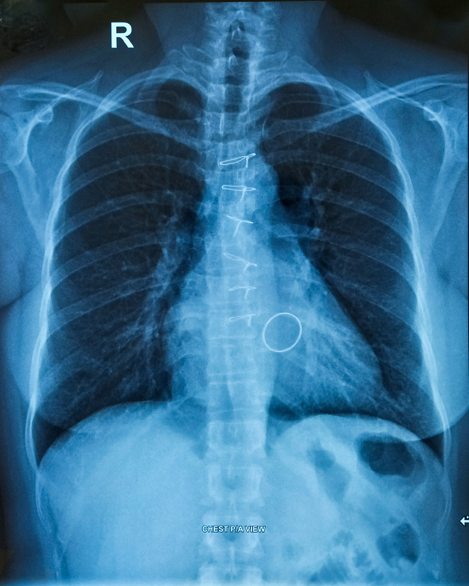 胸片检查能查出哪些病？常见疾病和病变