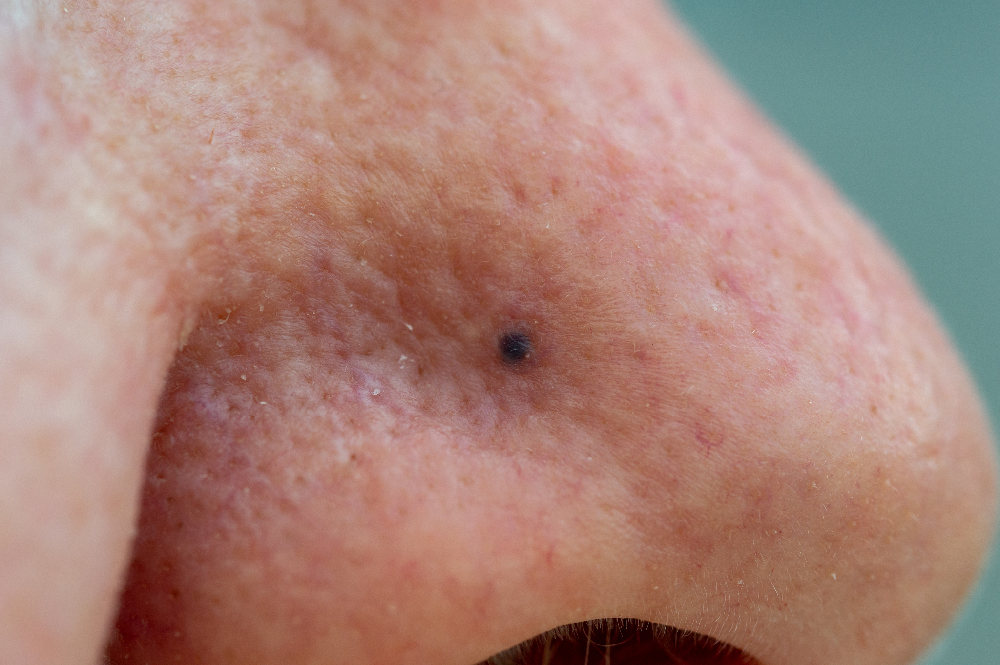blue nevus on senior woman's nose. close up.
