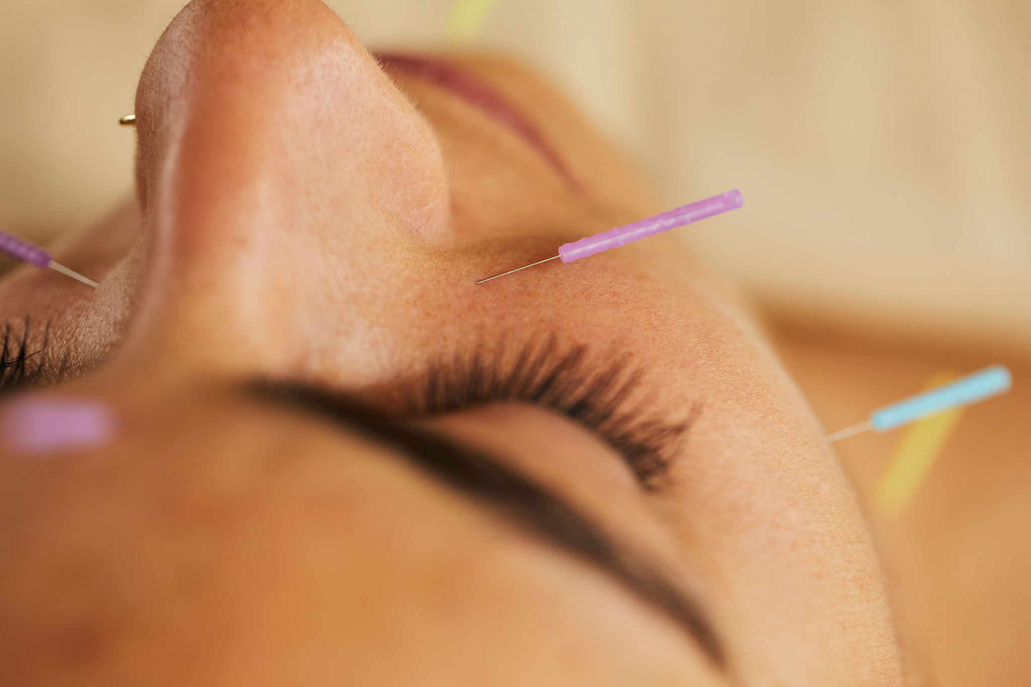 young woman lying on a bed during an acupuncture session