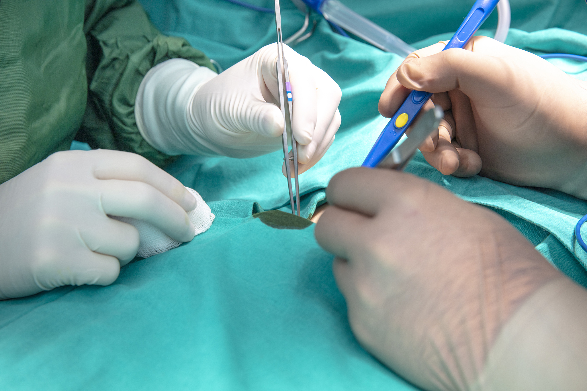 hands of doctors performing surgery in hospital operating room