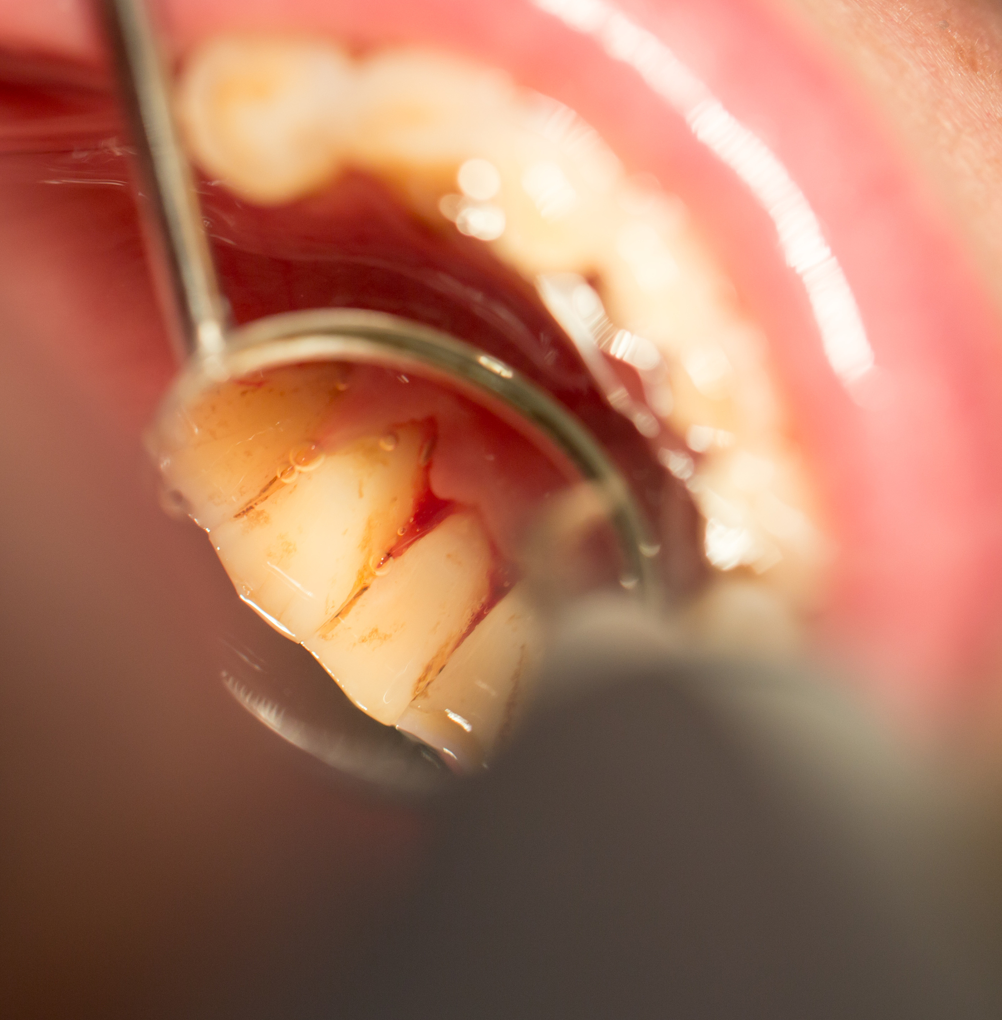 涂抹牙膏对于治疗牙龈萎缩、牙龈肿痛、压根敏感有好处吗
