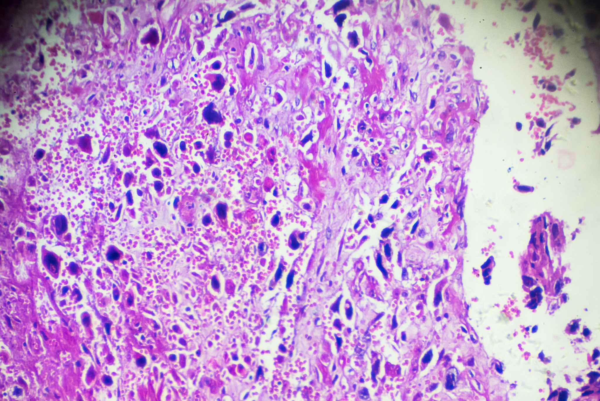 溃疡性结肠炎ulcerative colitisUC又称为慢性非特异性溃疡性结肠炎是一种至今病因尚不明确的直肠、结肠黏膜病症以腹痛、腹泻、黏液便、血便为常见的临床表现且病程迁延较难根治有癌变倾向已被世界卫生组织列为现代难治病之一。不改变大意换个说法