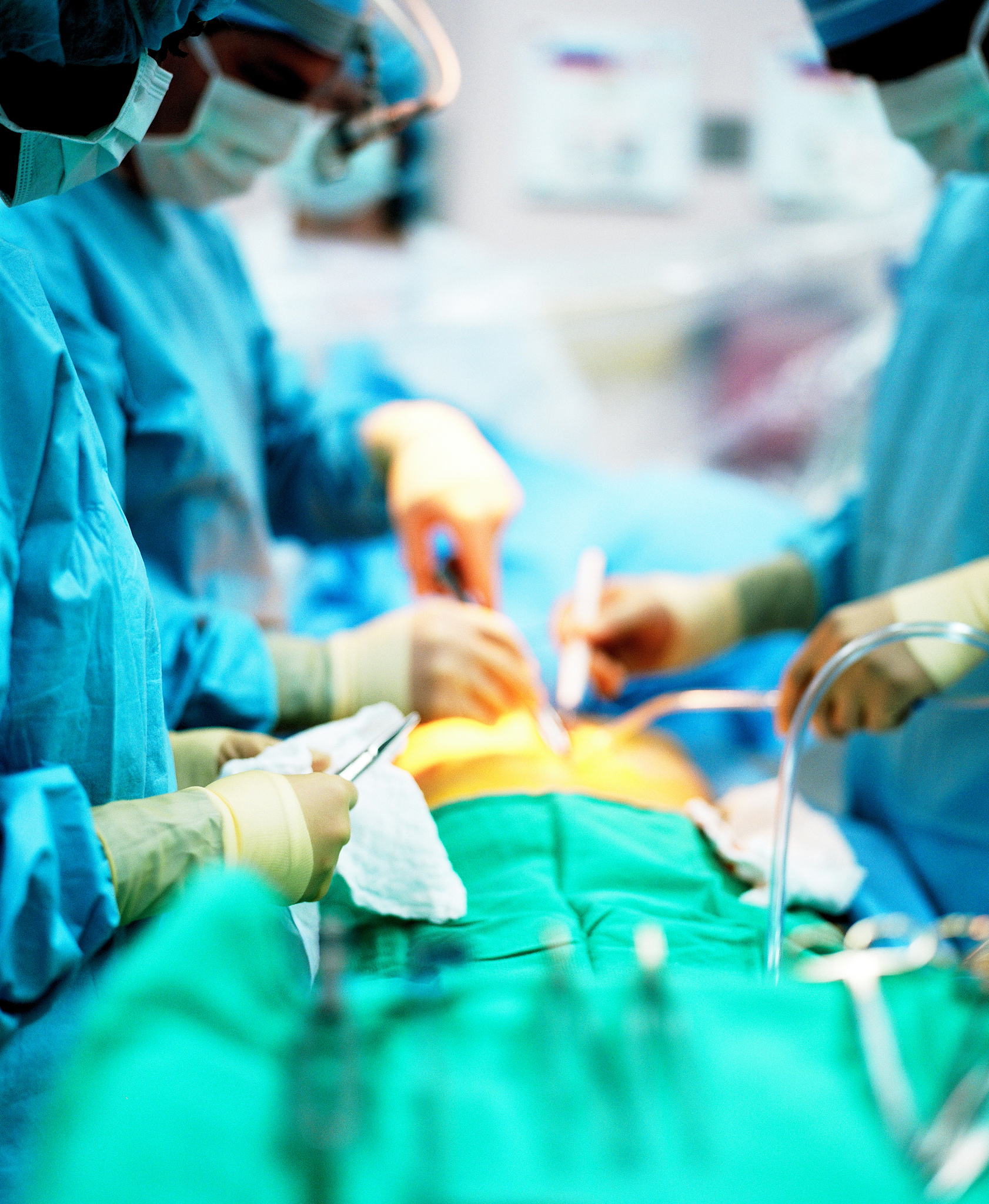 小切口阑尾手术：治疗急性阑尾炎的微创选择