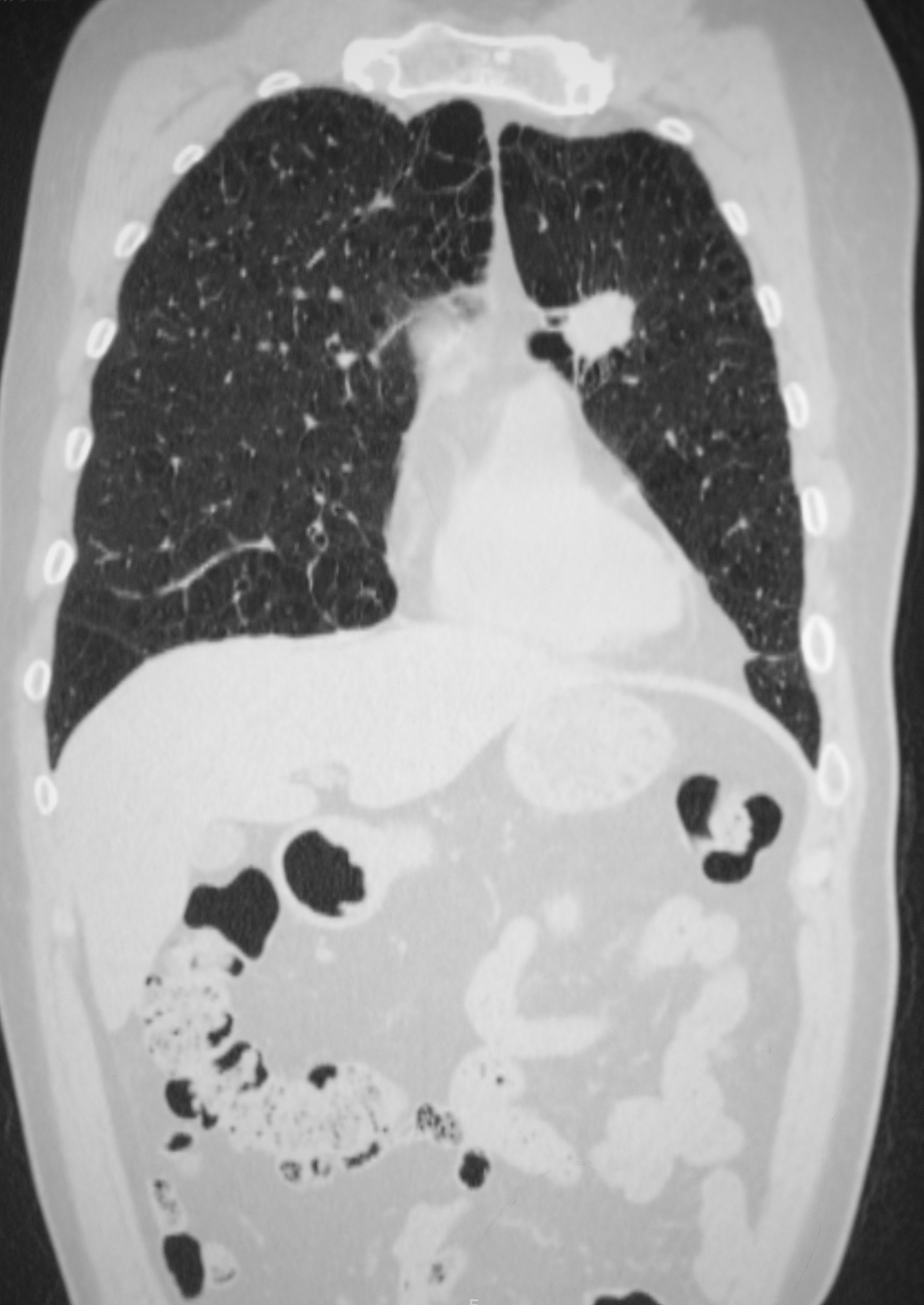 肺癌晚期影像学表现：诊断和鉴别