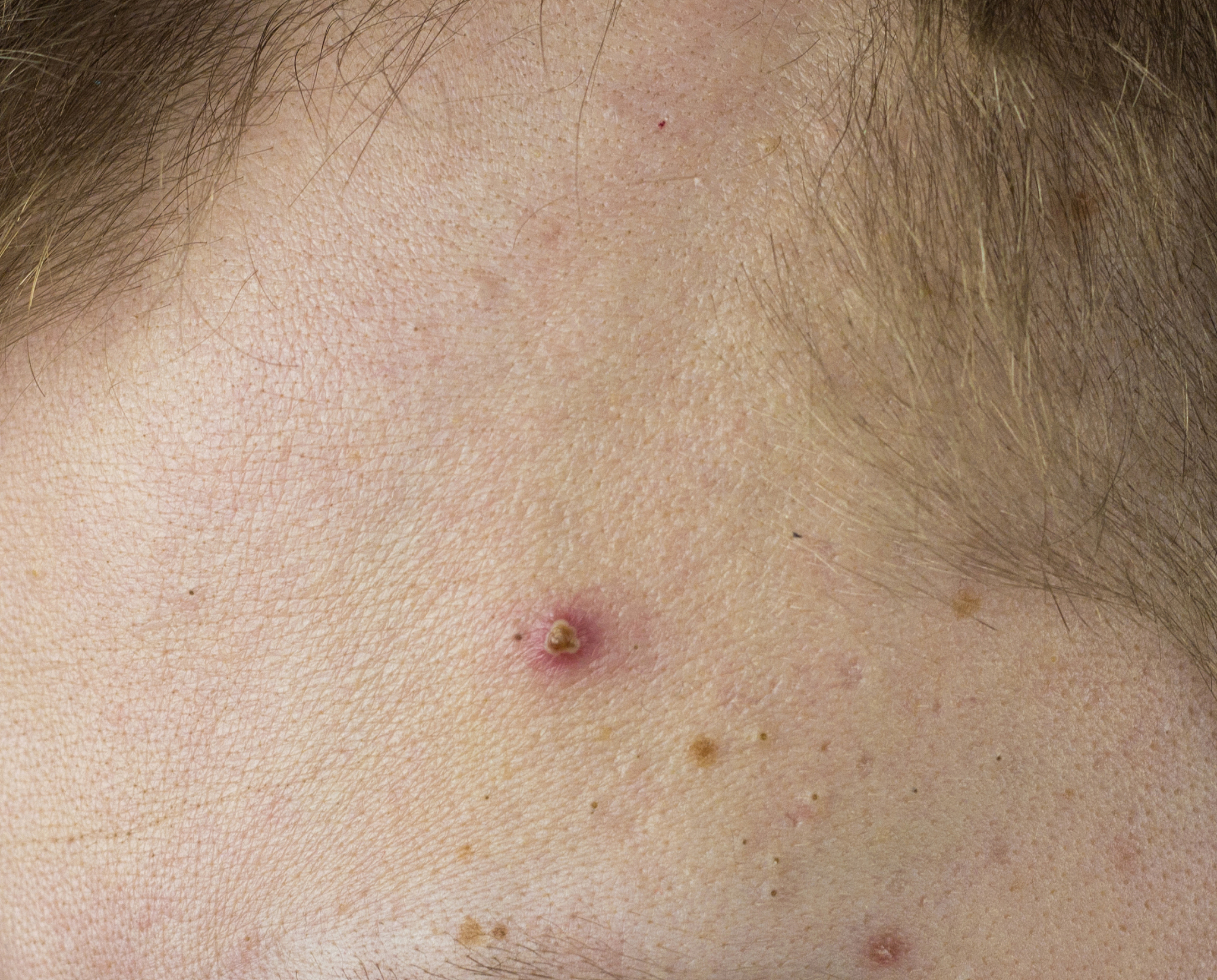 big red pimple on the man's forehead, close-up, problem skin, wh
