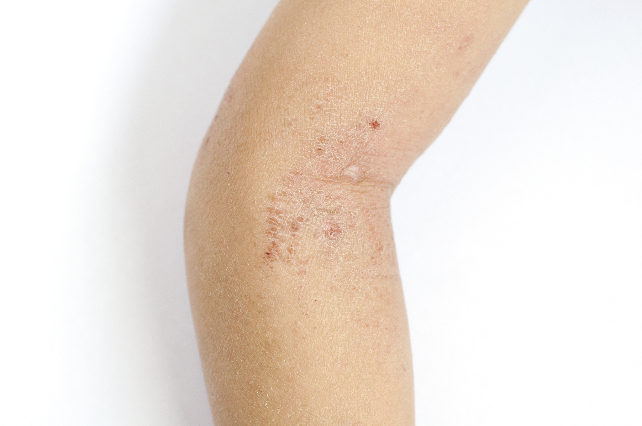 胳膊上有白色小点，痒！是湿疹吗？ - 皮膚病症分析