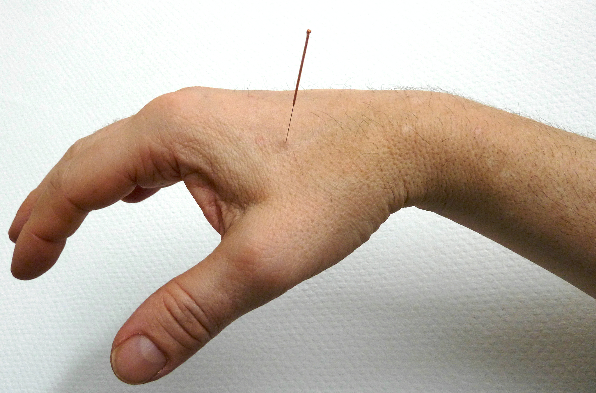 close-up of person with acupuncture needle