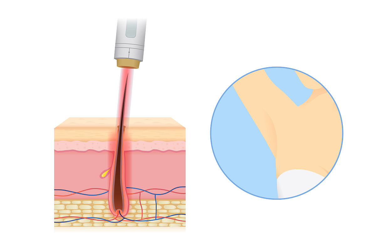 永久脱毛会有什么影响