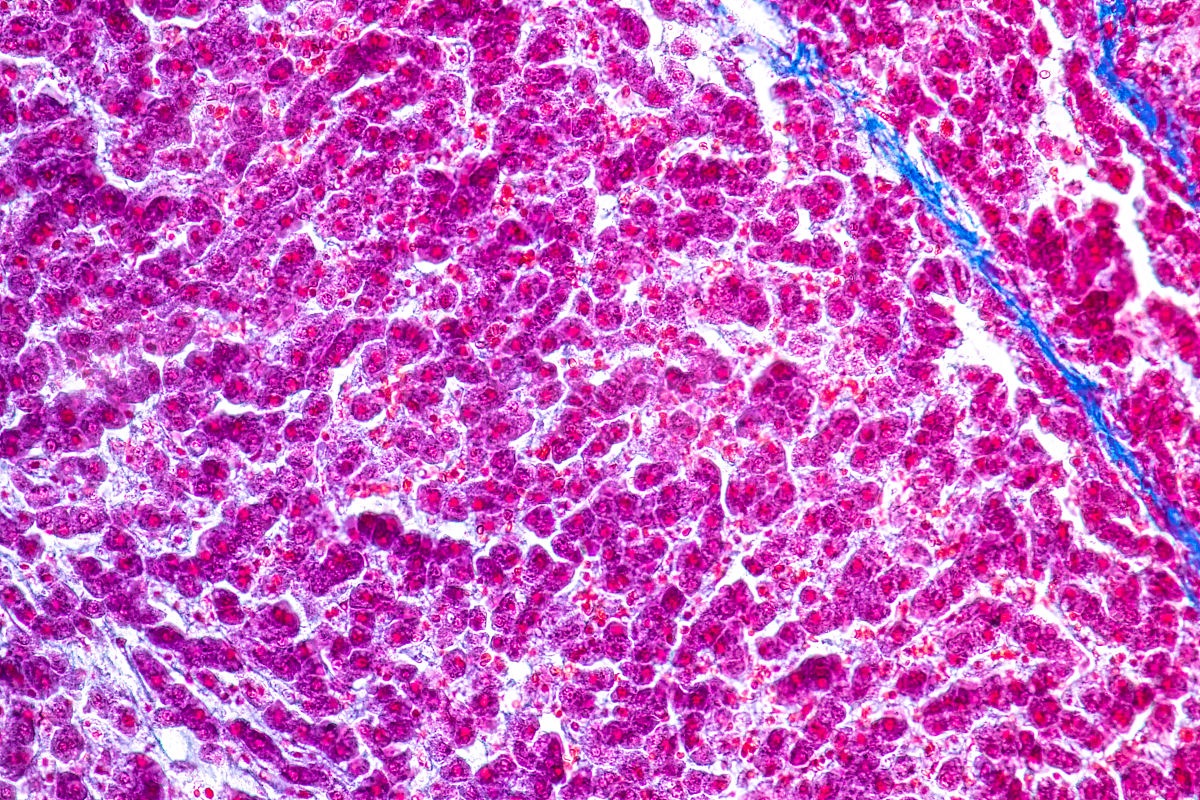 参与肝星状细胞转化为纤维母细胞的炎症因子情况