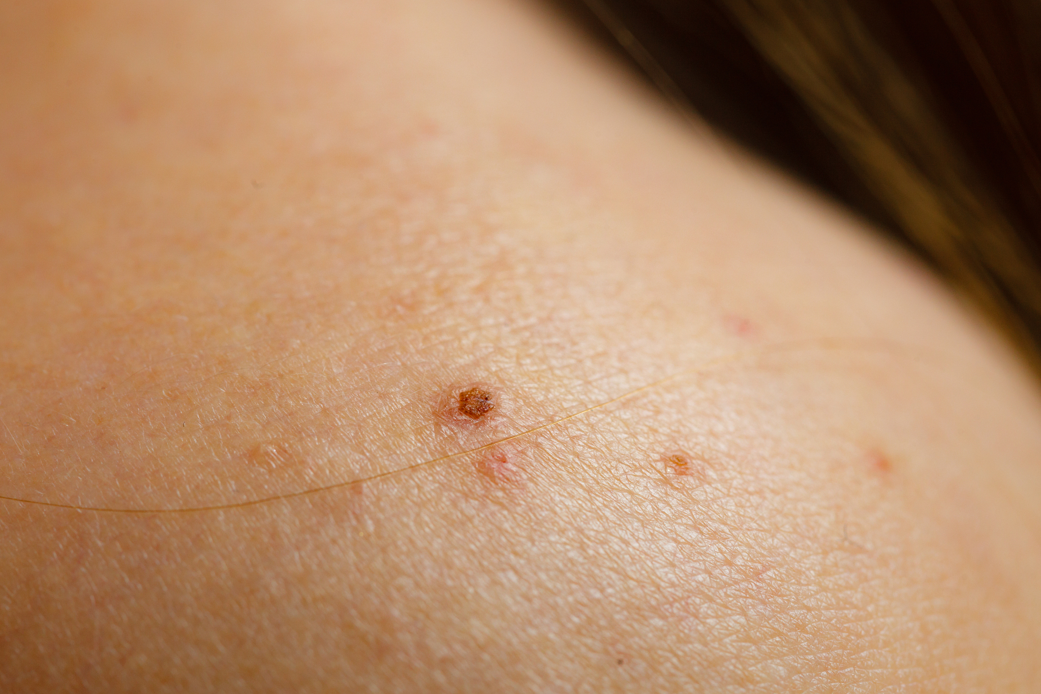 closeup skin with acne moles and red spots.