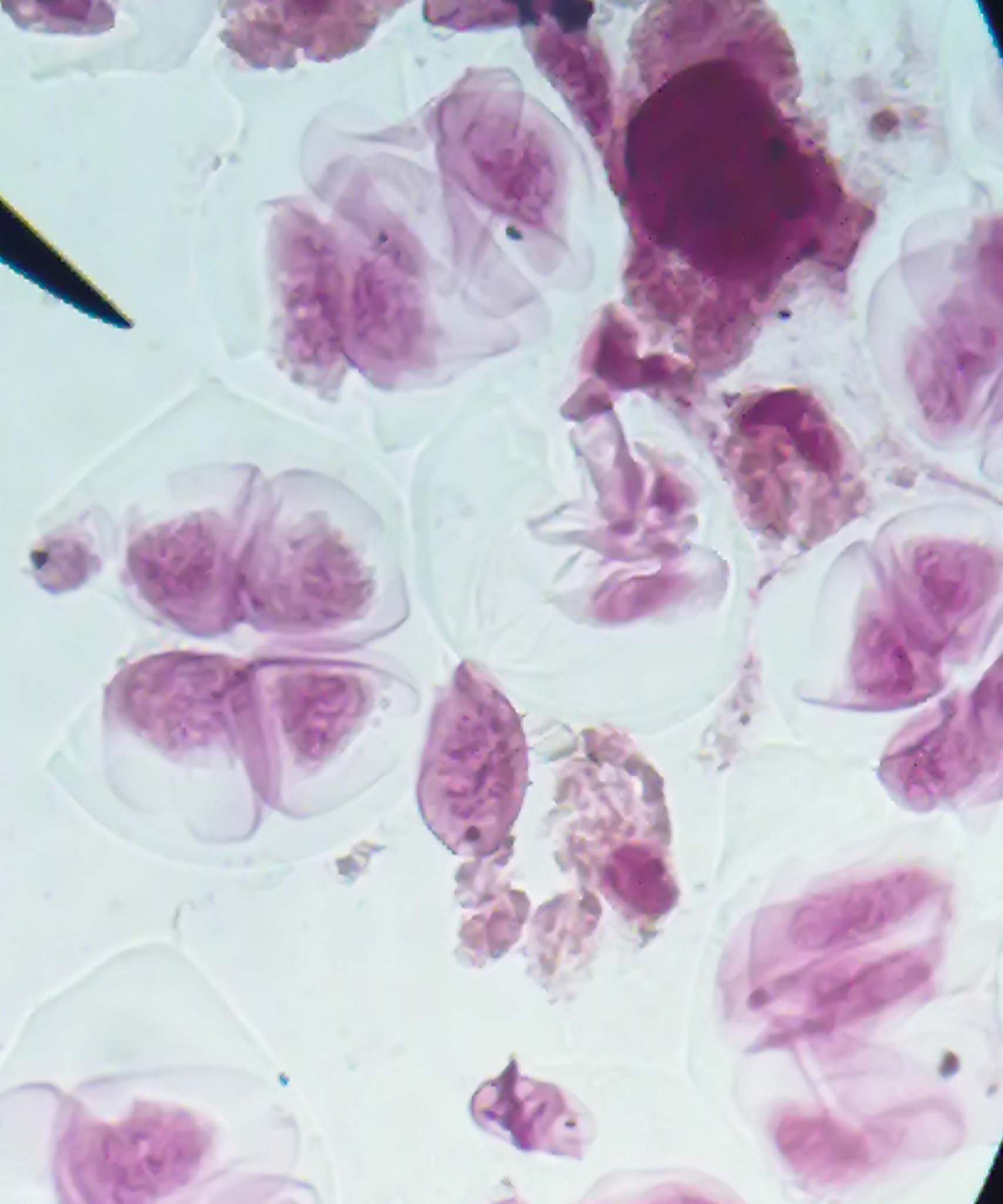 乳腺癌病理切片技术：诊断与治疗的重要依据