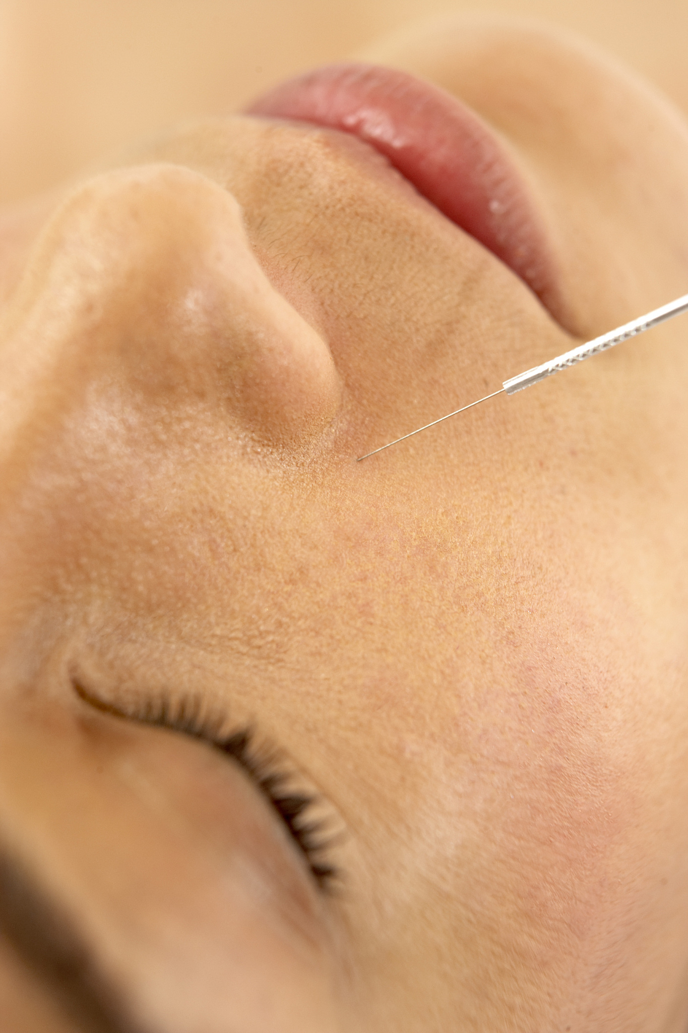acupuncture needle on face