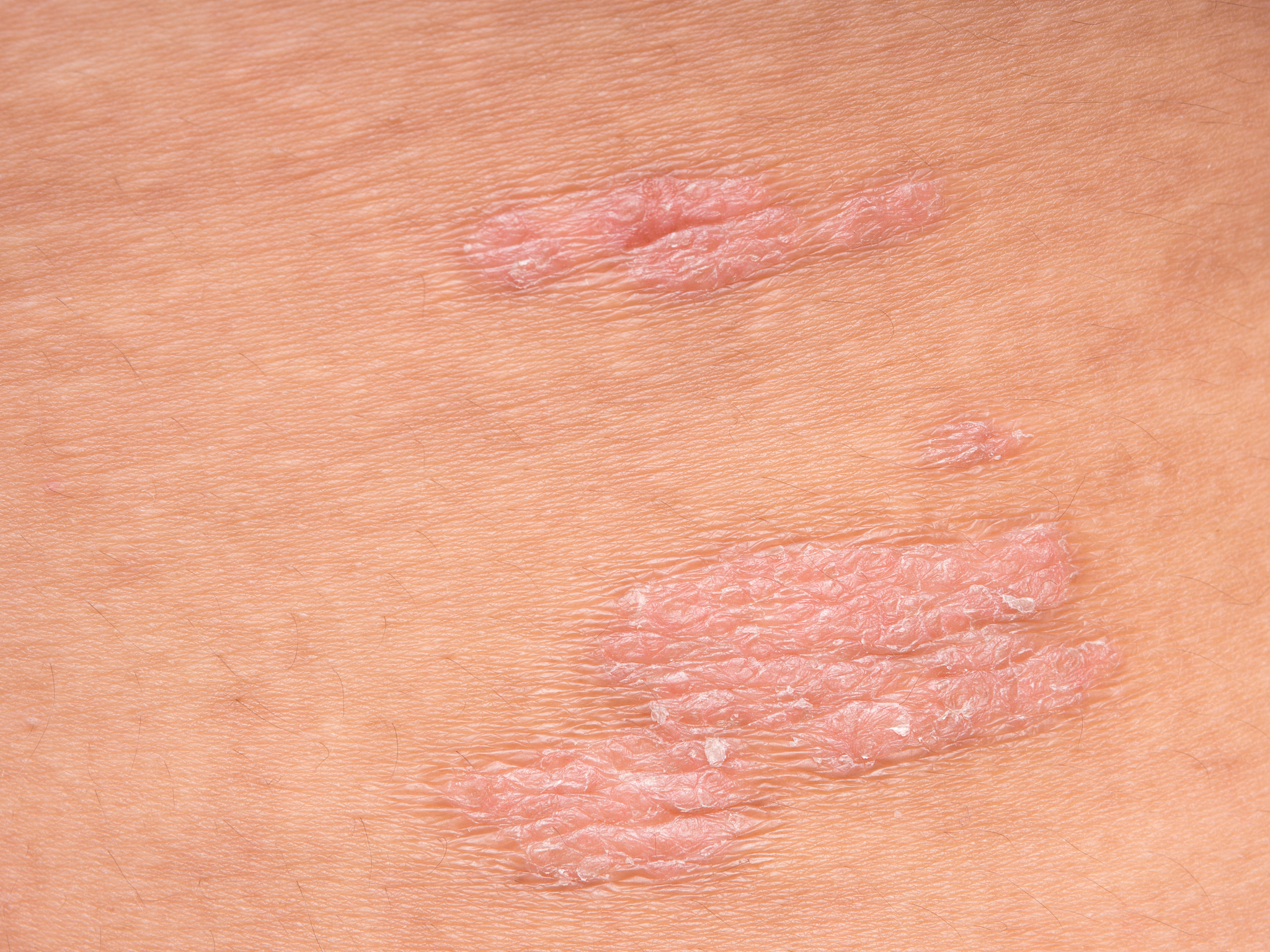 阴囊脱皮的原因有哪些？_男性私处护理指南