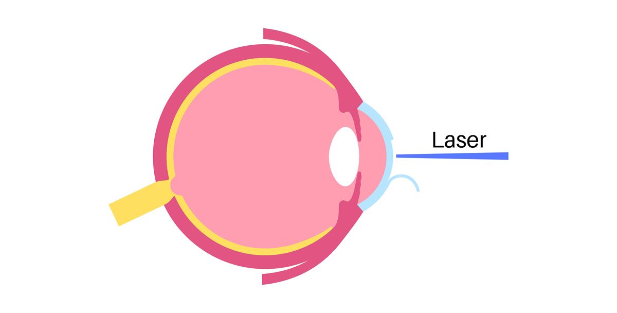 散瞳对眼睛的伤害有多大
