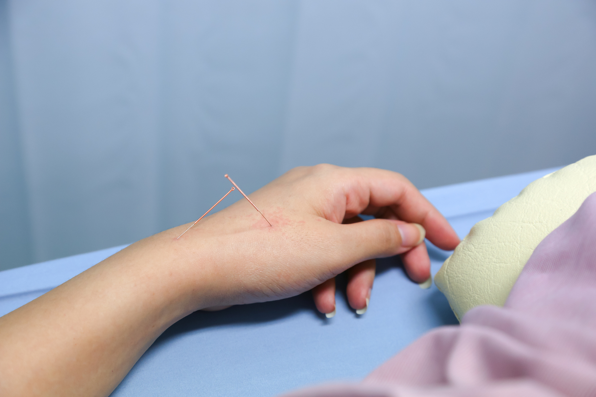 hand of a woman with acupuncture treatment