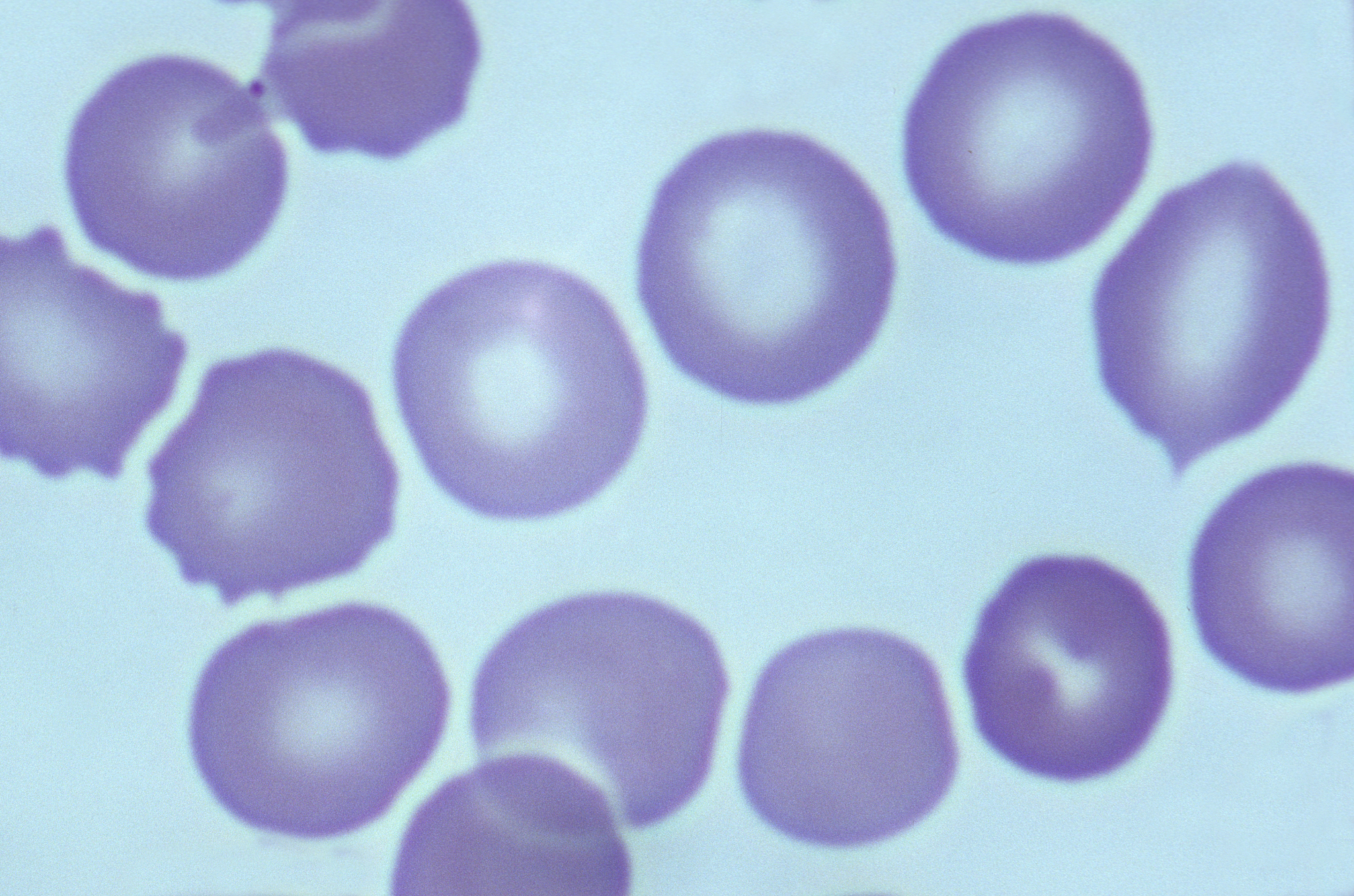 如何预防缺铁性贫血？