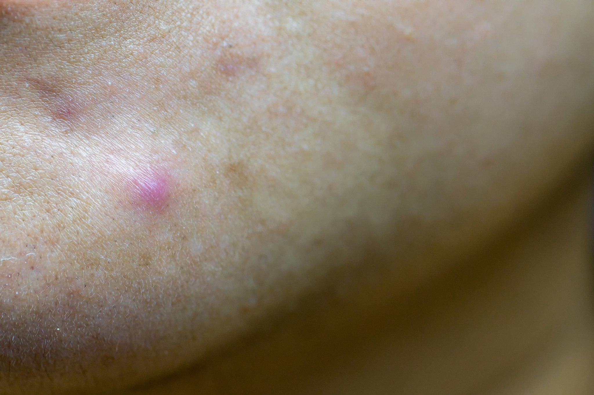 photo of nodular cystic acne skin. chronic acne skin on woman su