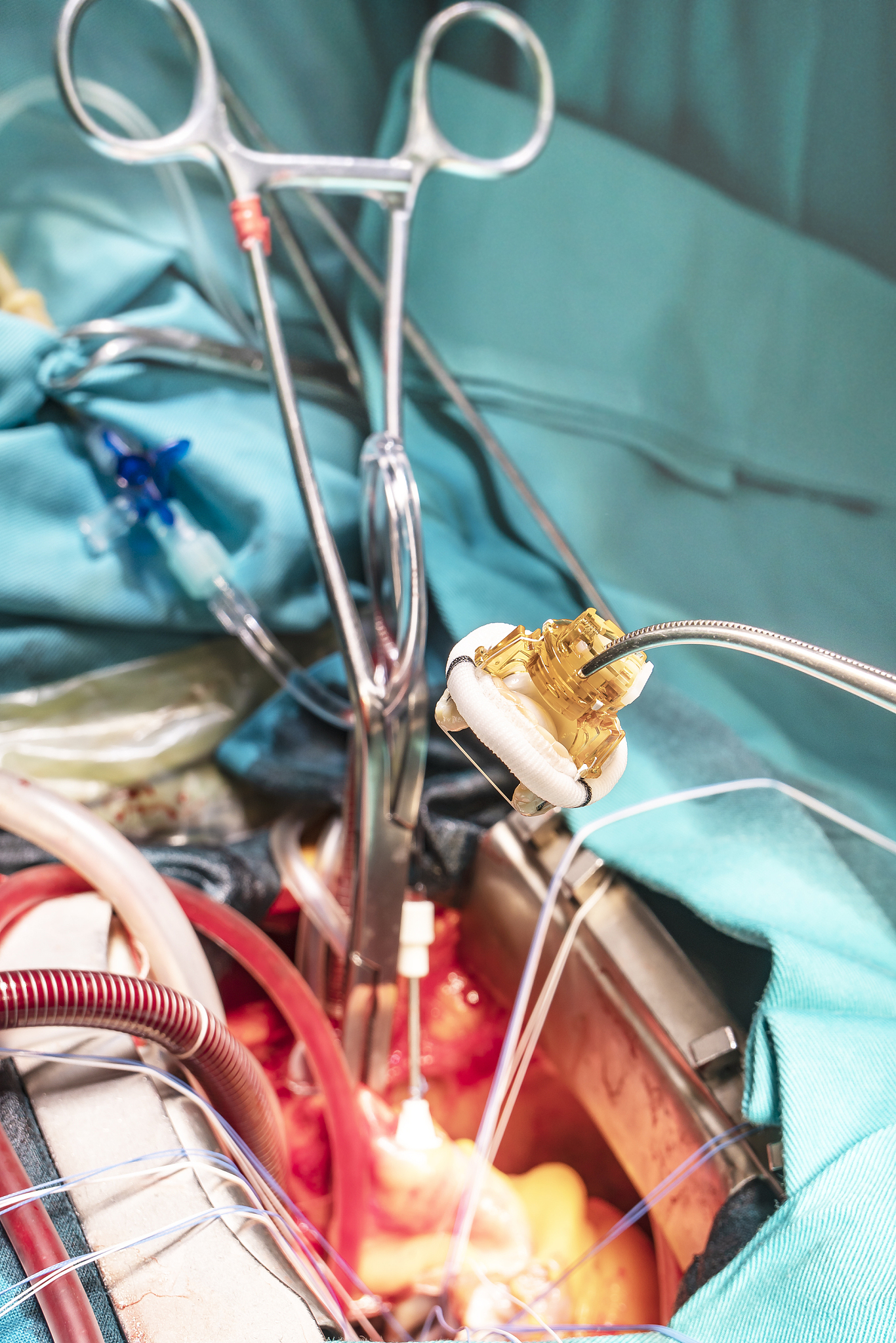 heart valve surgery