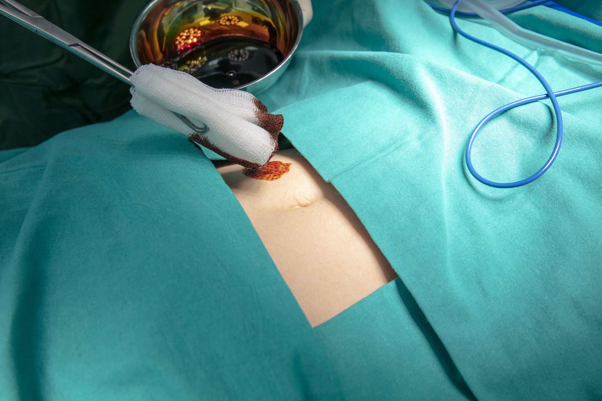 hands of doctors performing surgery in hospital operating room