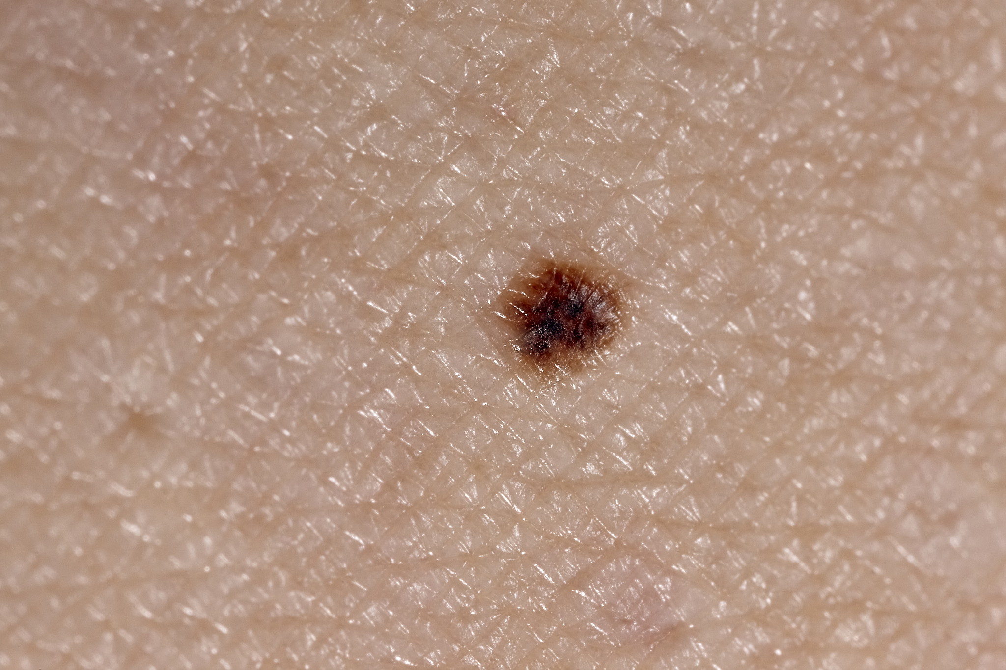 skin melanoma 2x magnification