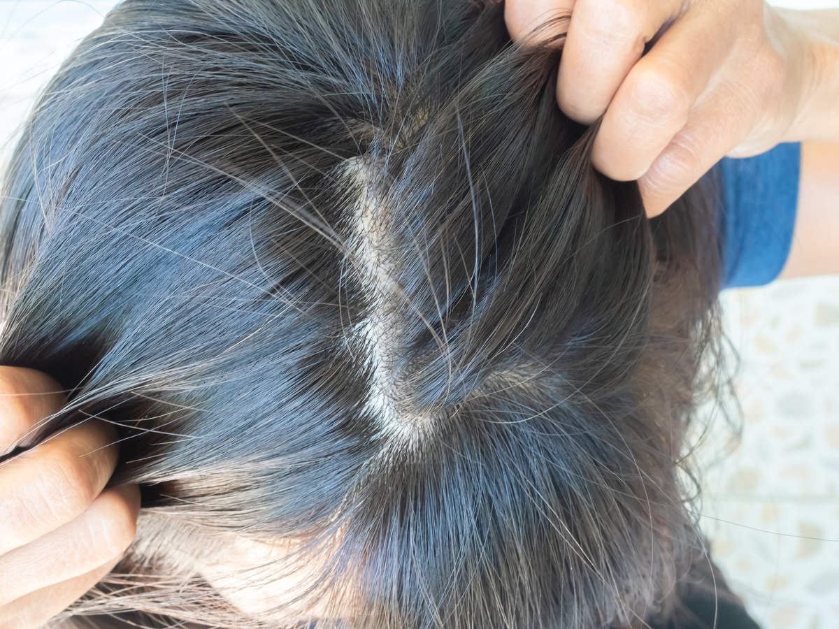 头皮屑多怎么办