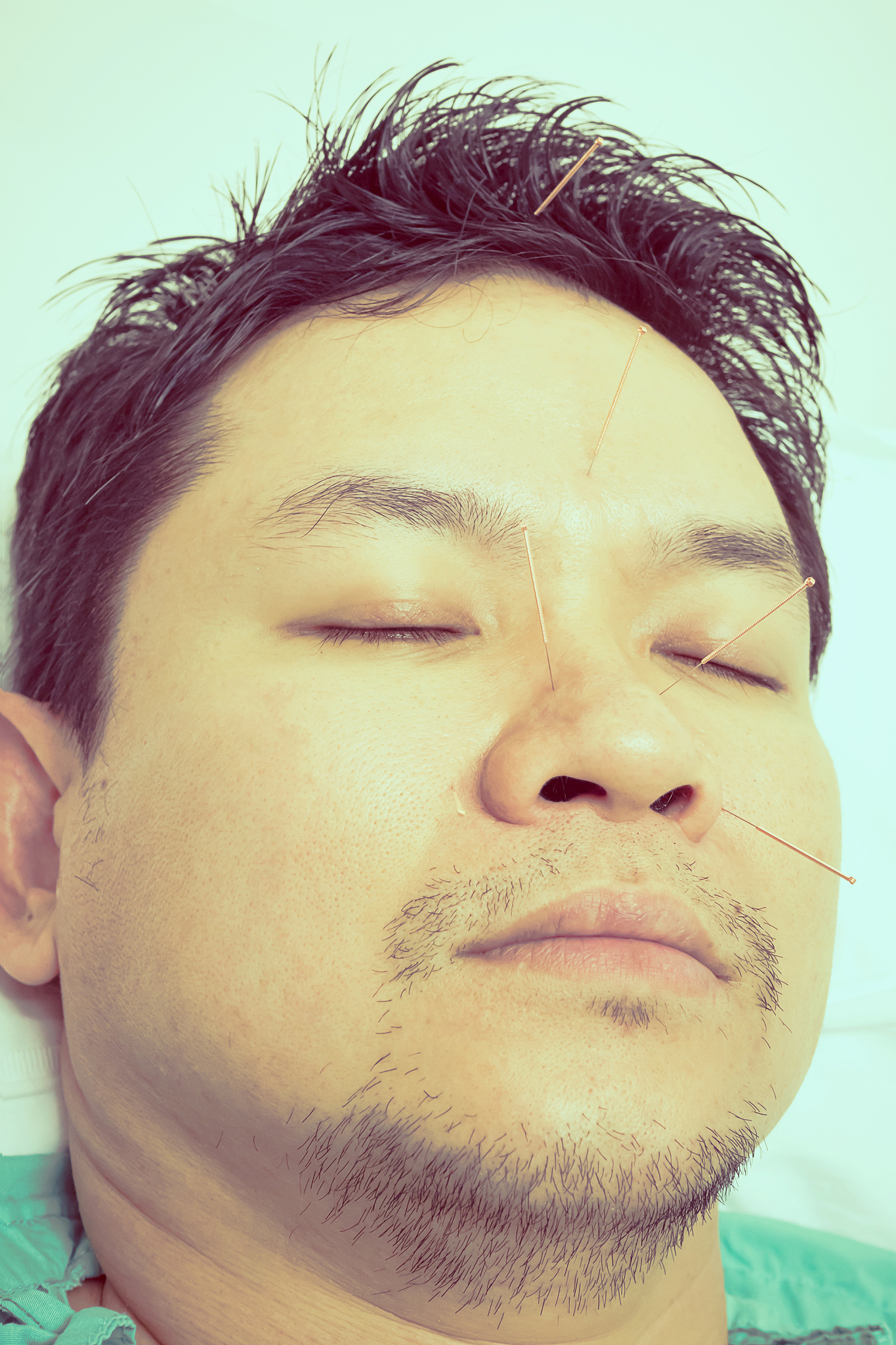 close-up of patients with acupuncture needles at medical clinic