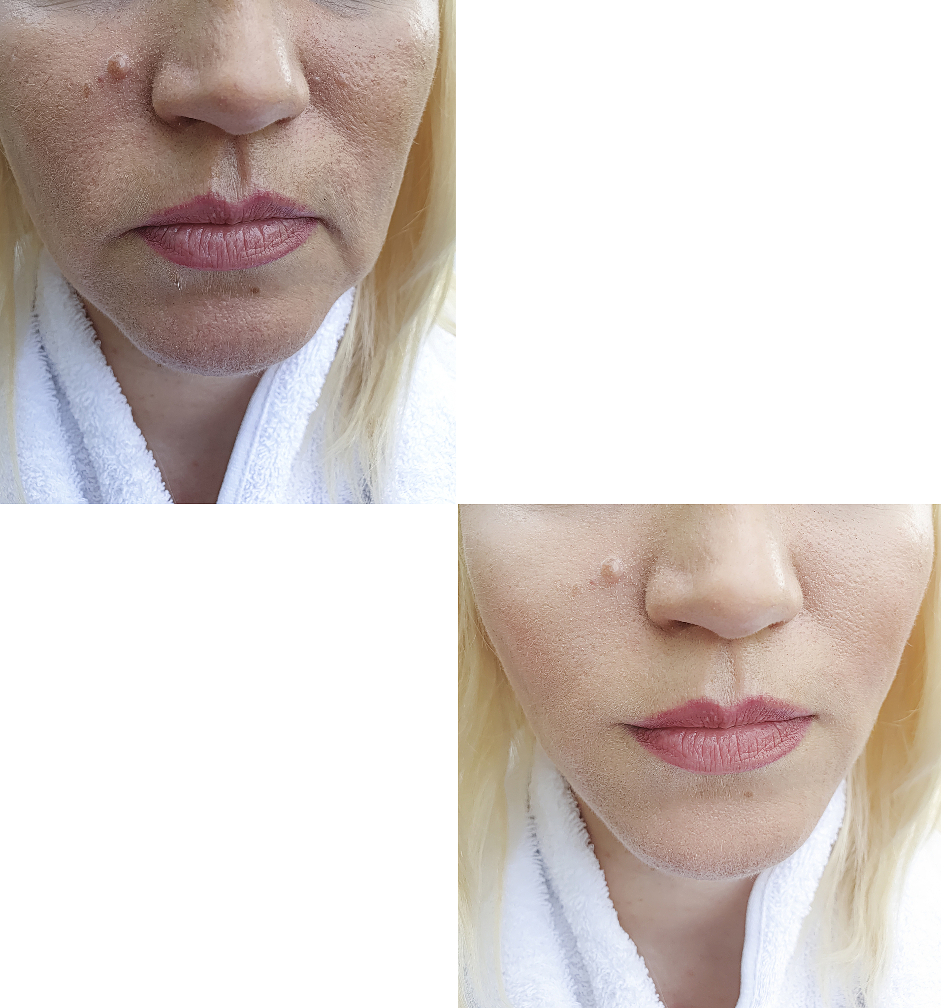 异维A酸需要与食物同服吗？ | 提高吸收率，减轻胃肠不适