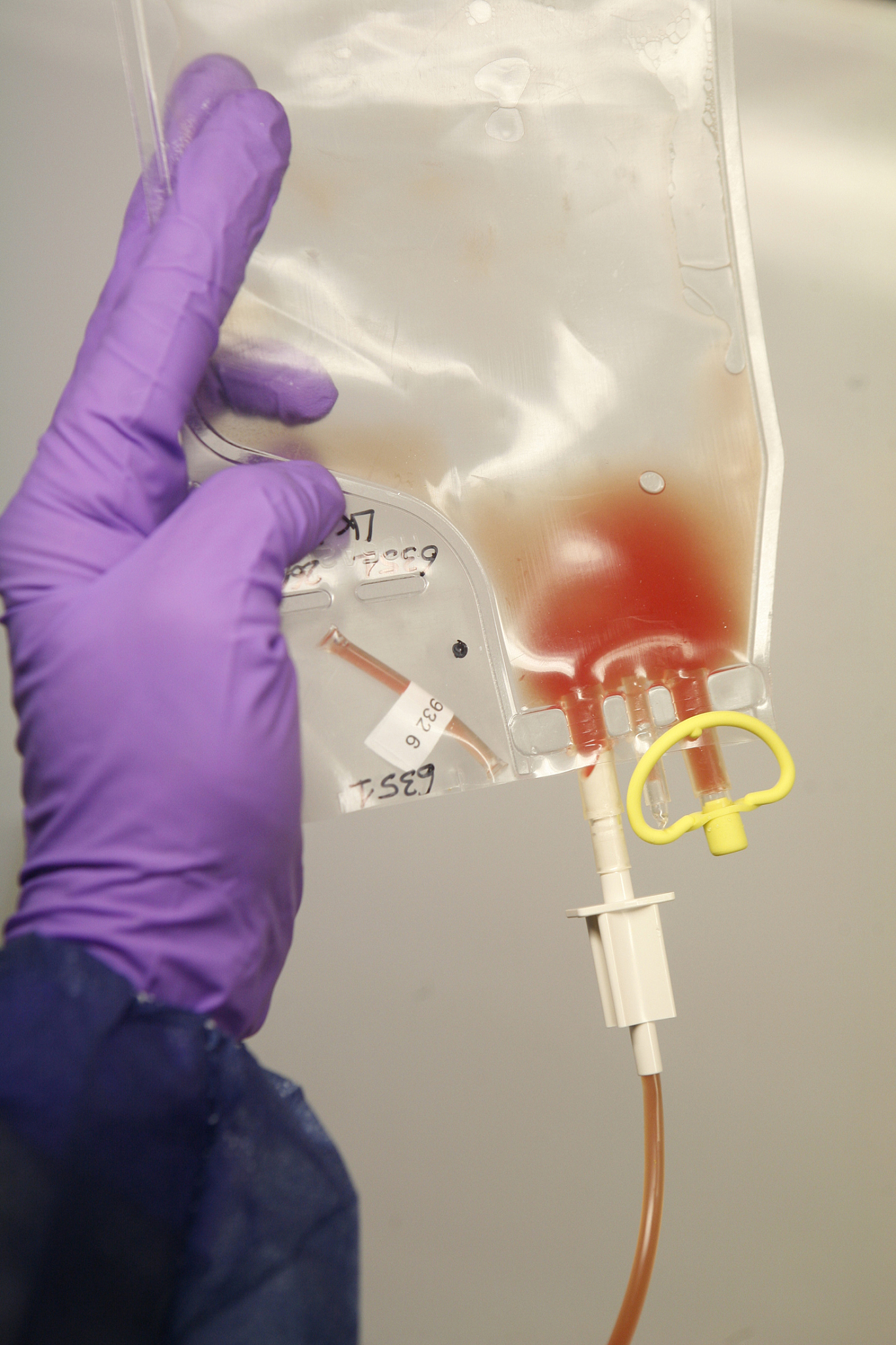 癌性腹水引流：缓解症状，改善生活质量