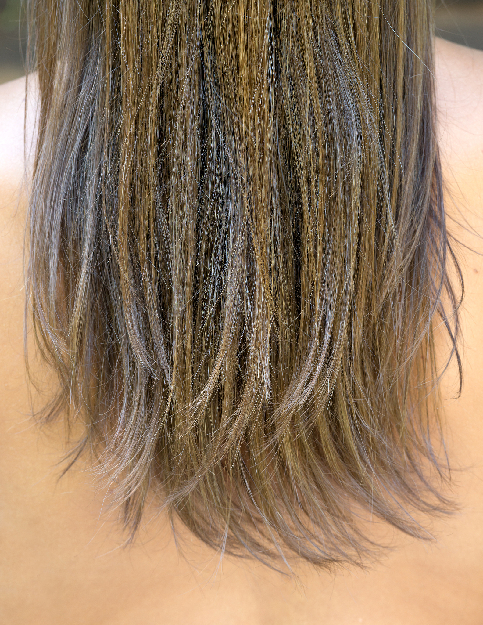 How long hair transplant last Will hair loss again But no blood vessels for new planted follicles what is the maximum number of grafts used for hair transplant