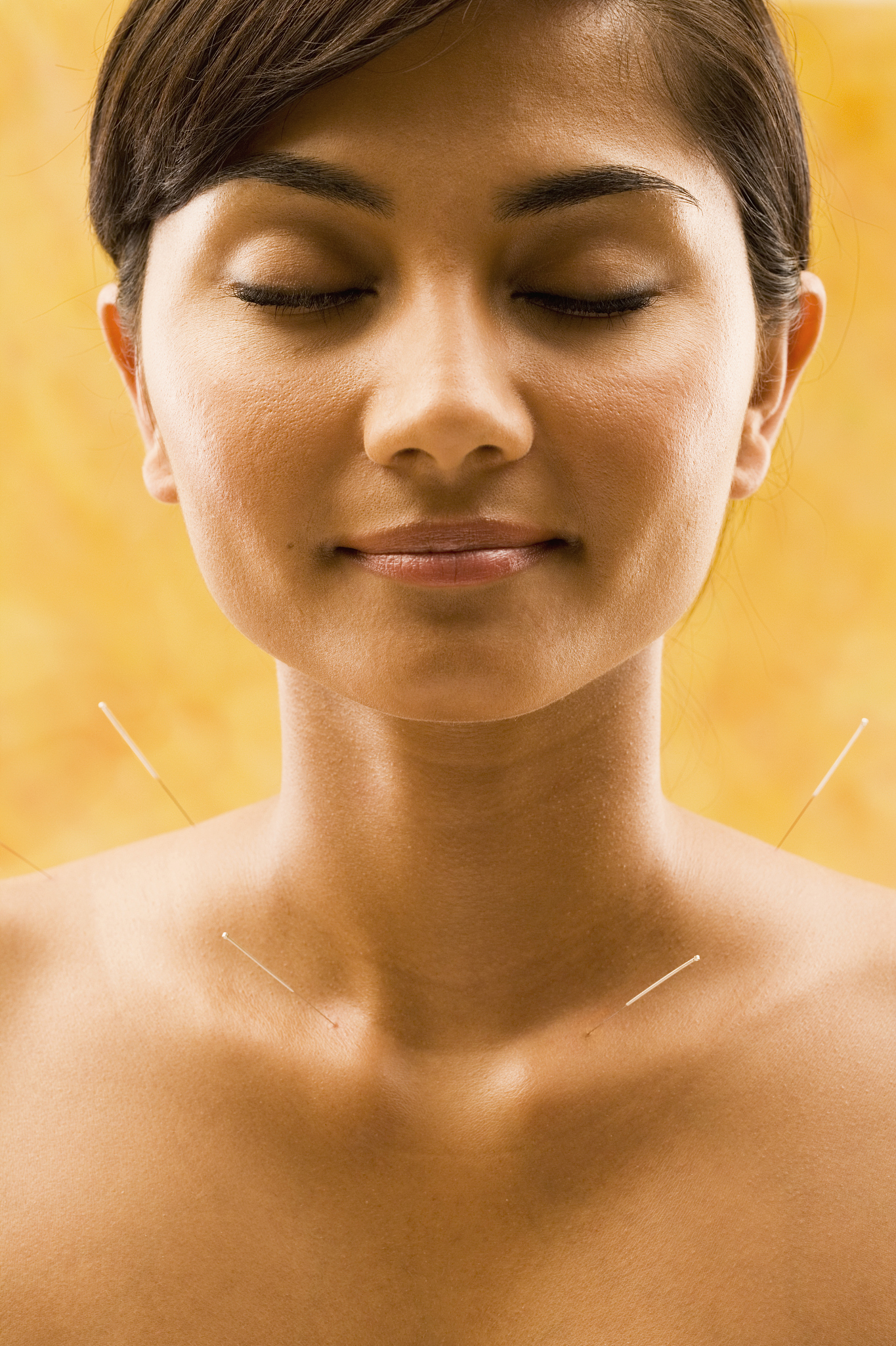 young woman getting acupuncture treatment