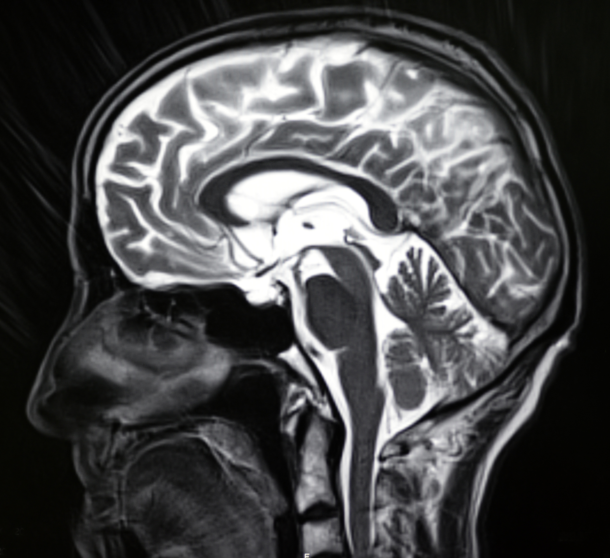 闭合性颅脑损伤硬膜外血肿清除术：术前护理指南