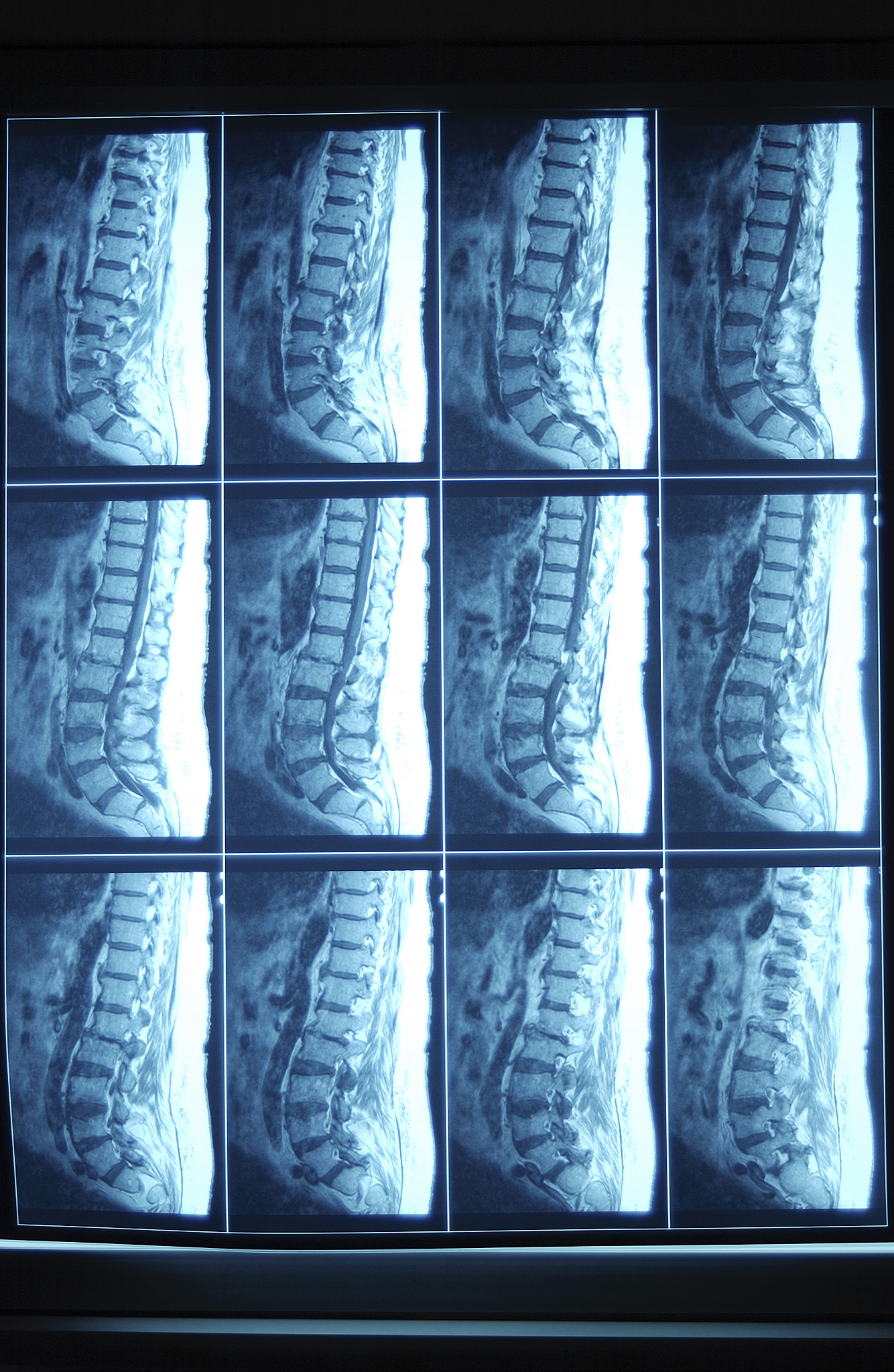 骨科常见疾病：治疗方法、预防措施及康复指南