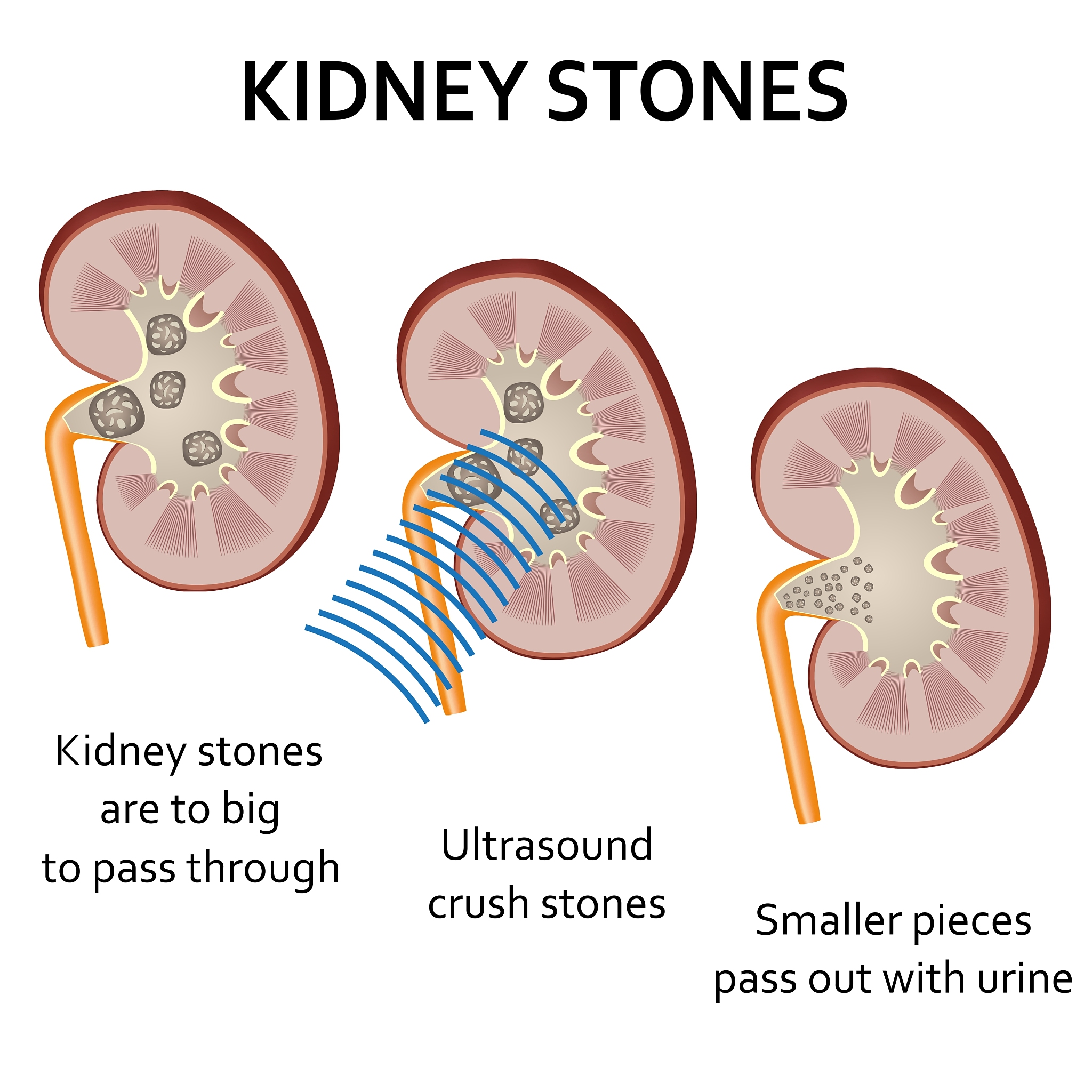 输尿管结石合并右肾积水怎么办？饮食建议及注意事项